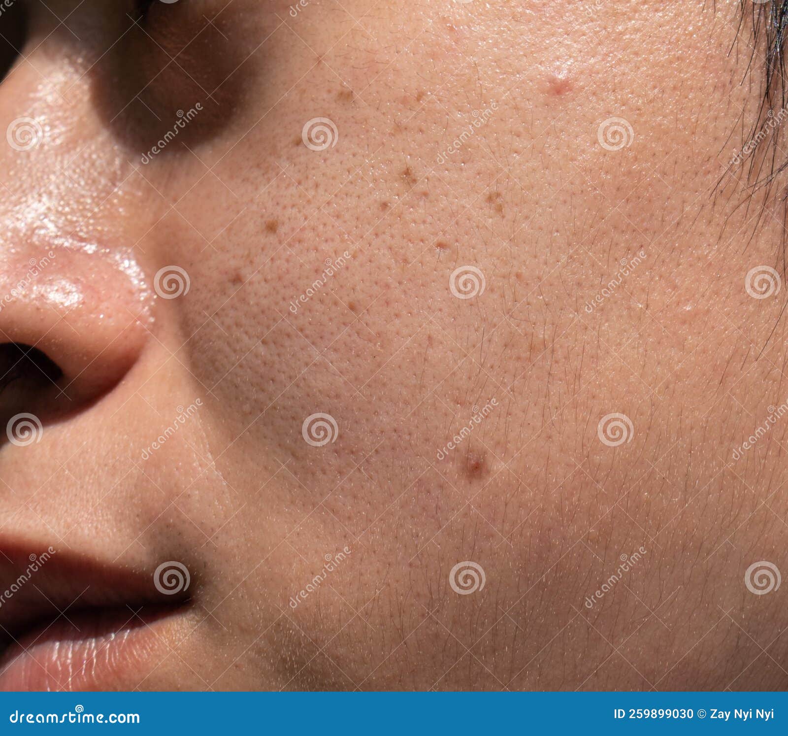 Dark Spots Called Age Spots And On The Face Of Asian Man They Are Also dark-spots-called-age-spots-and-on-the-face-of-asian-man-they-are-also