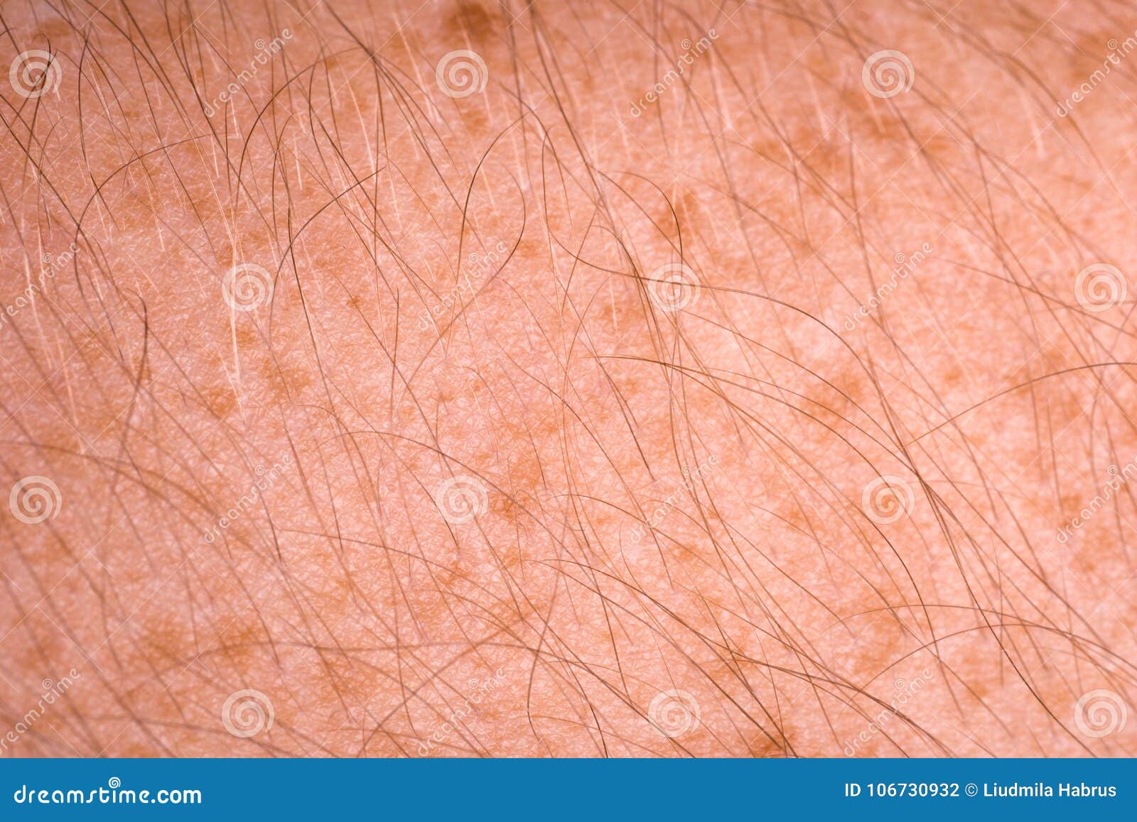 Dark Spots On Male Hairy Arm Stock Photo Image Of Cancer Closeup