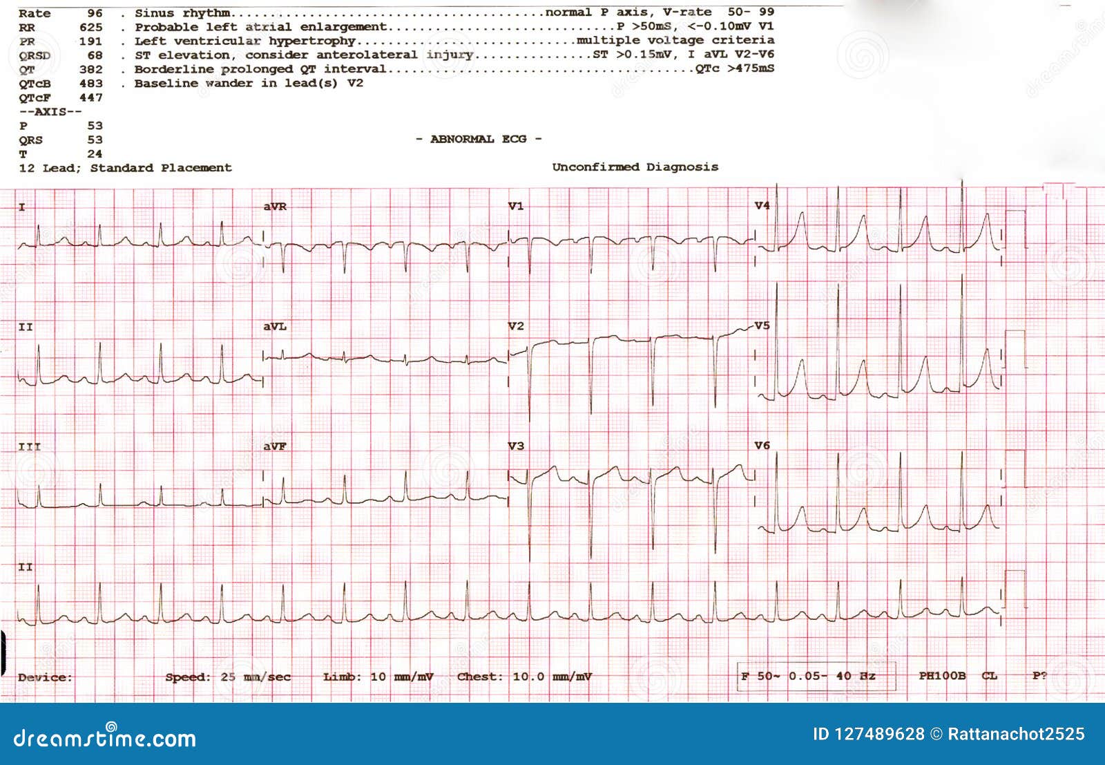 normal cardiograph normal cardiograph