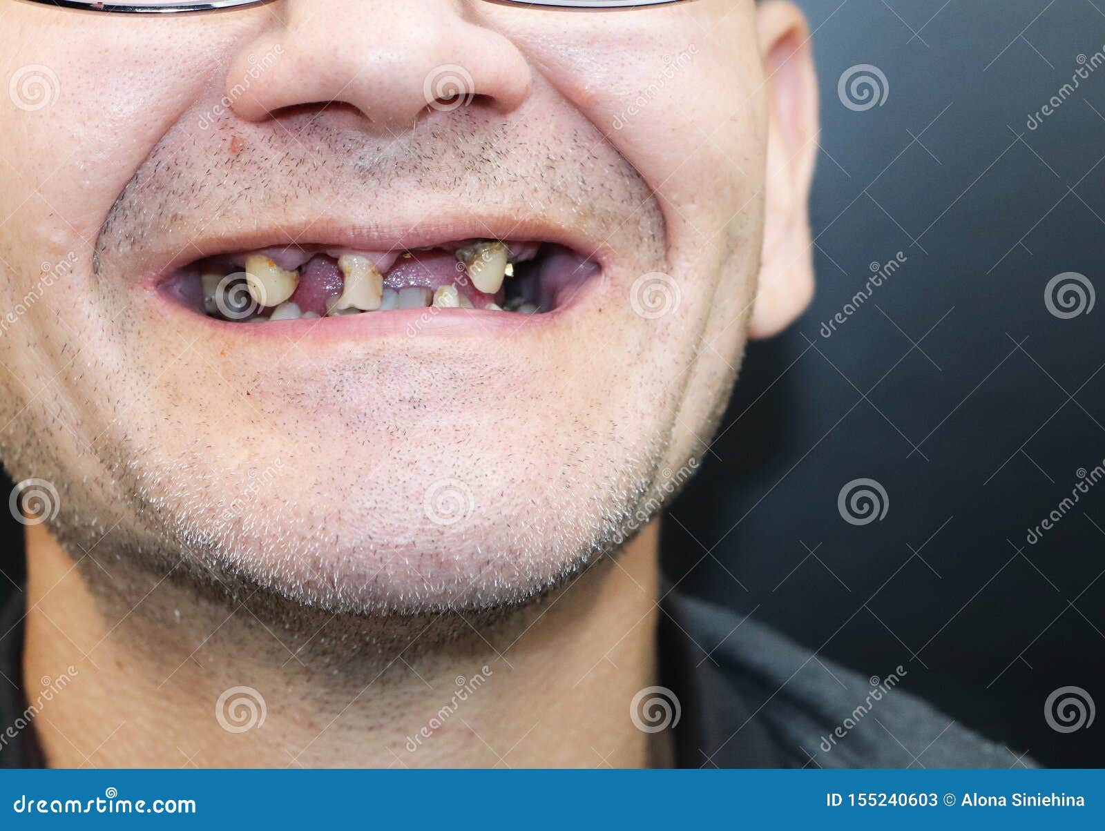 De Rotte Tanden, Uit, En Zwarte Vielen De Tanden Gekwetste Tanden Slechte Tandenvoorwaarde, Erosie, Bederf De Arts Afbeelding - Image of email, bederf: 155240603