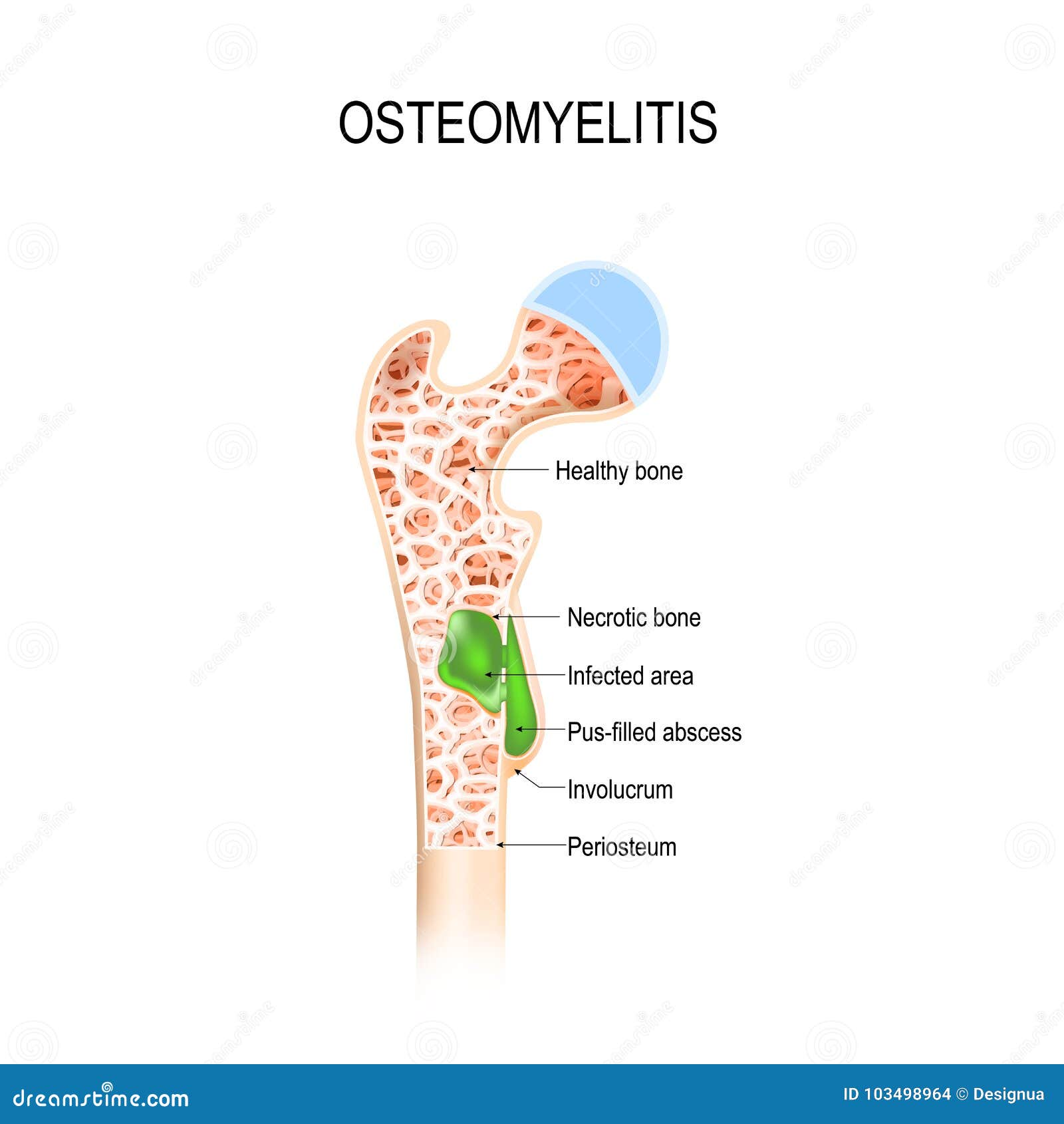 De Osteomyelitis is Besmetting in Het Been Vector Illustratie