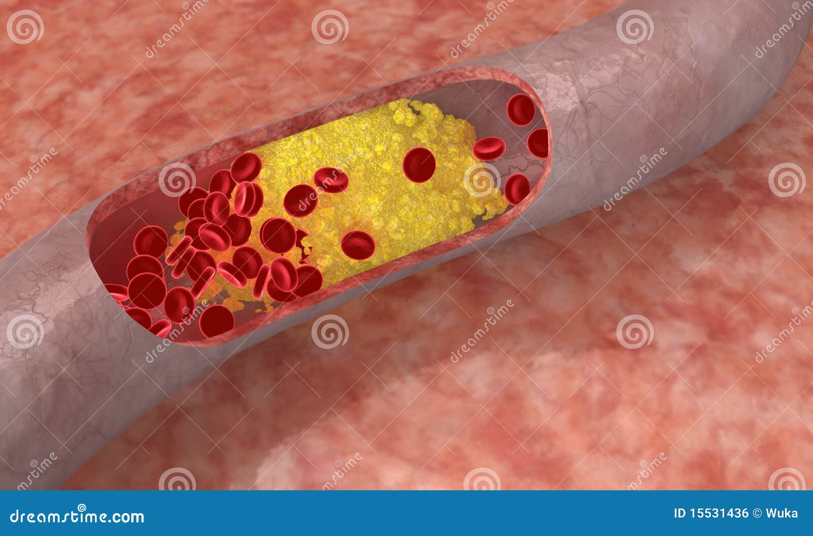 De Plaque Van De Cholesterol in Slagader Stock Illustratie