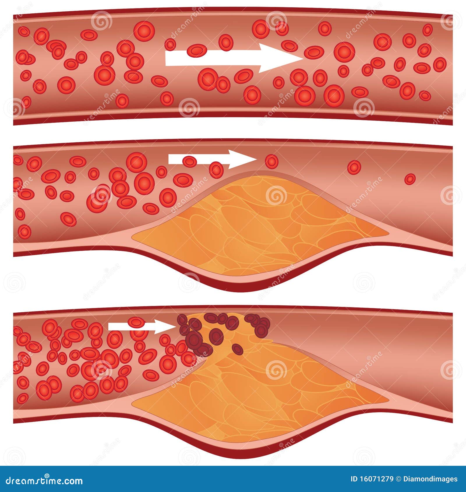 De Plaque Van De Cholesterol in Slagader Vector Illustratie