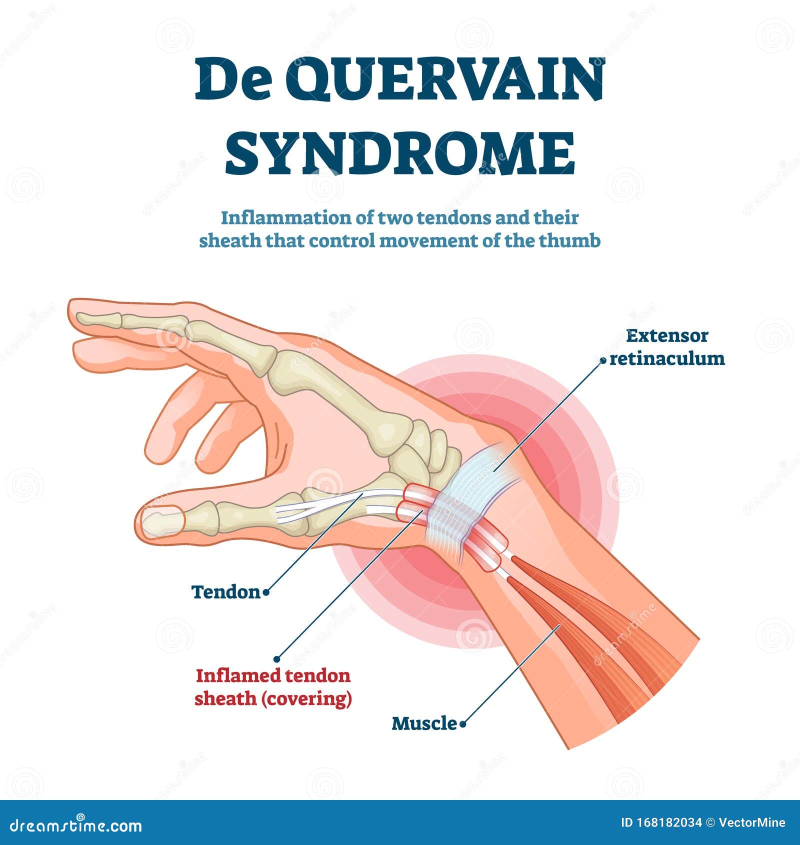 de quervain syndrome  . labeled thumb inflammation scheme