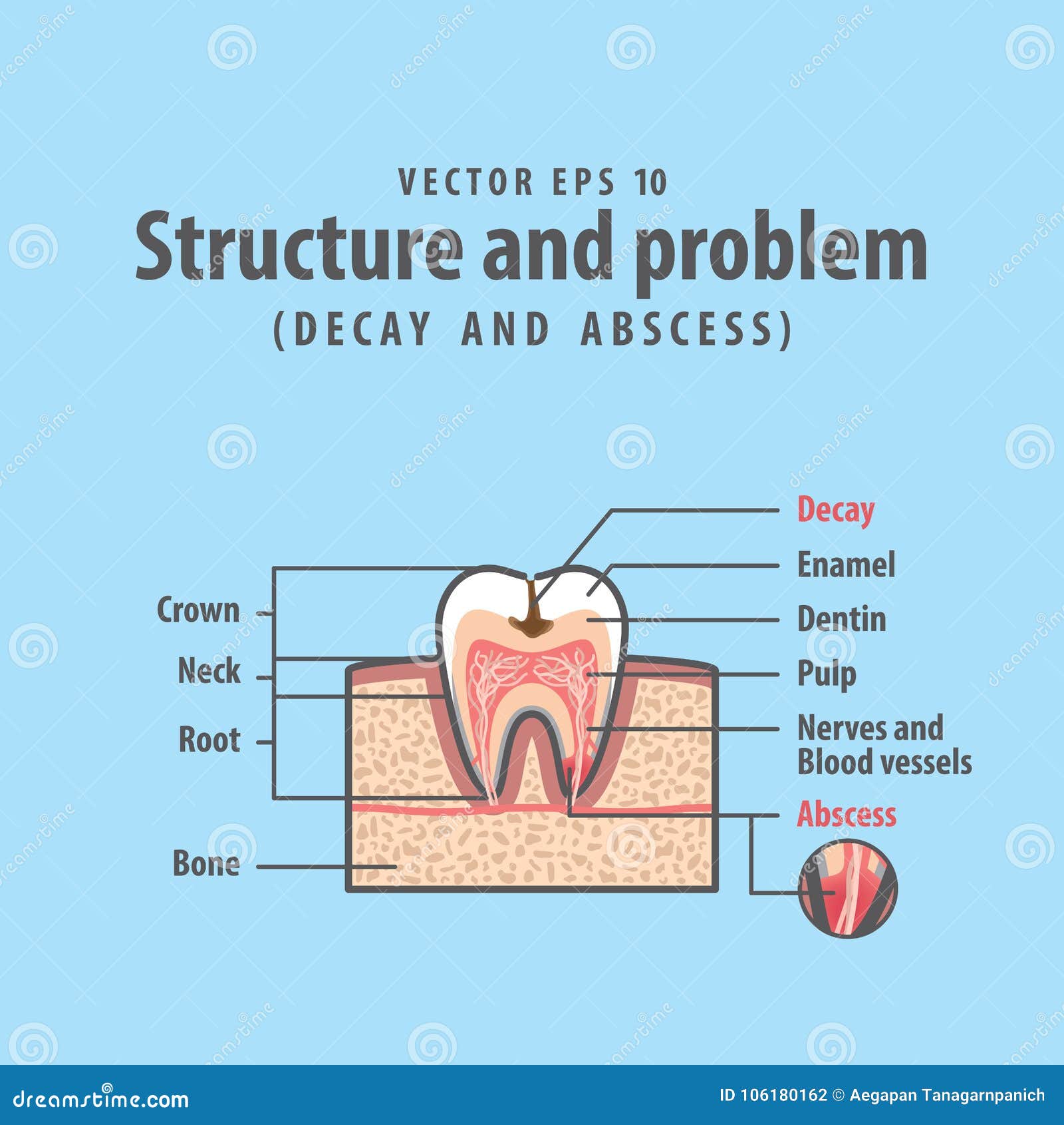 Decay and Abscess Crosssection Structure Inside Tooth Stock Vector