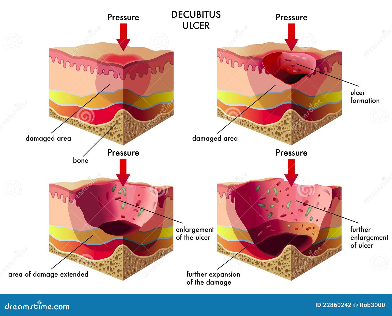 decubitus ulcer