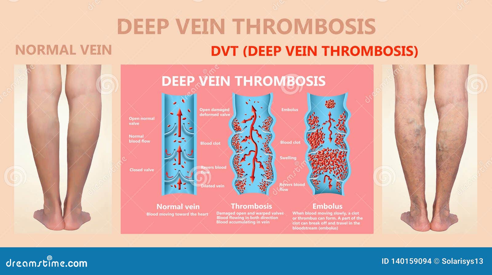 deep vein thrombosis or blood clots. embolus.