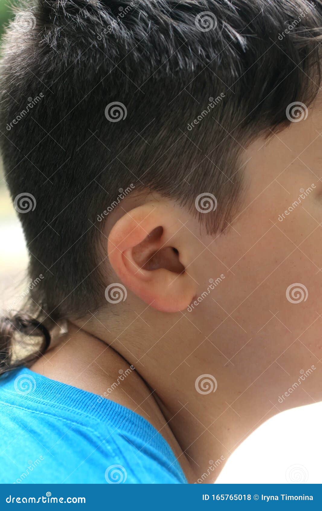deformation of the ear. irregular  of the auricle.