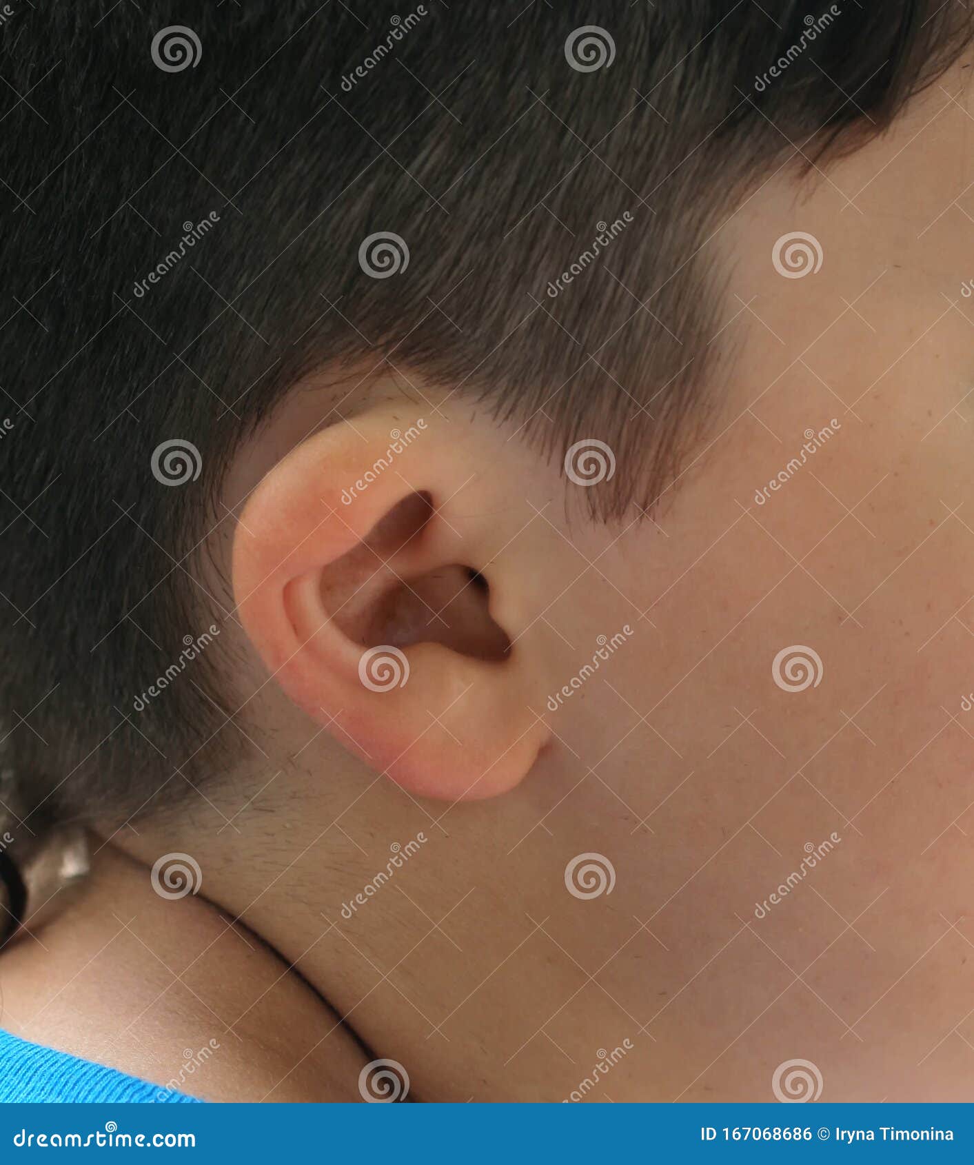 deformation of the ear. irregular  of the auricle.