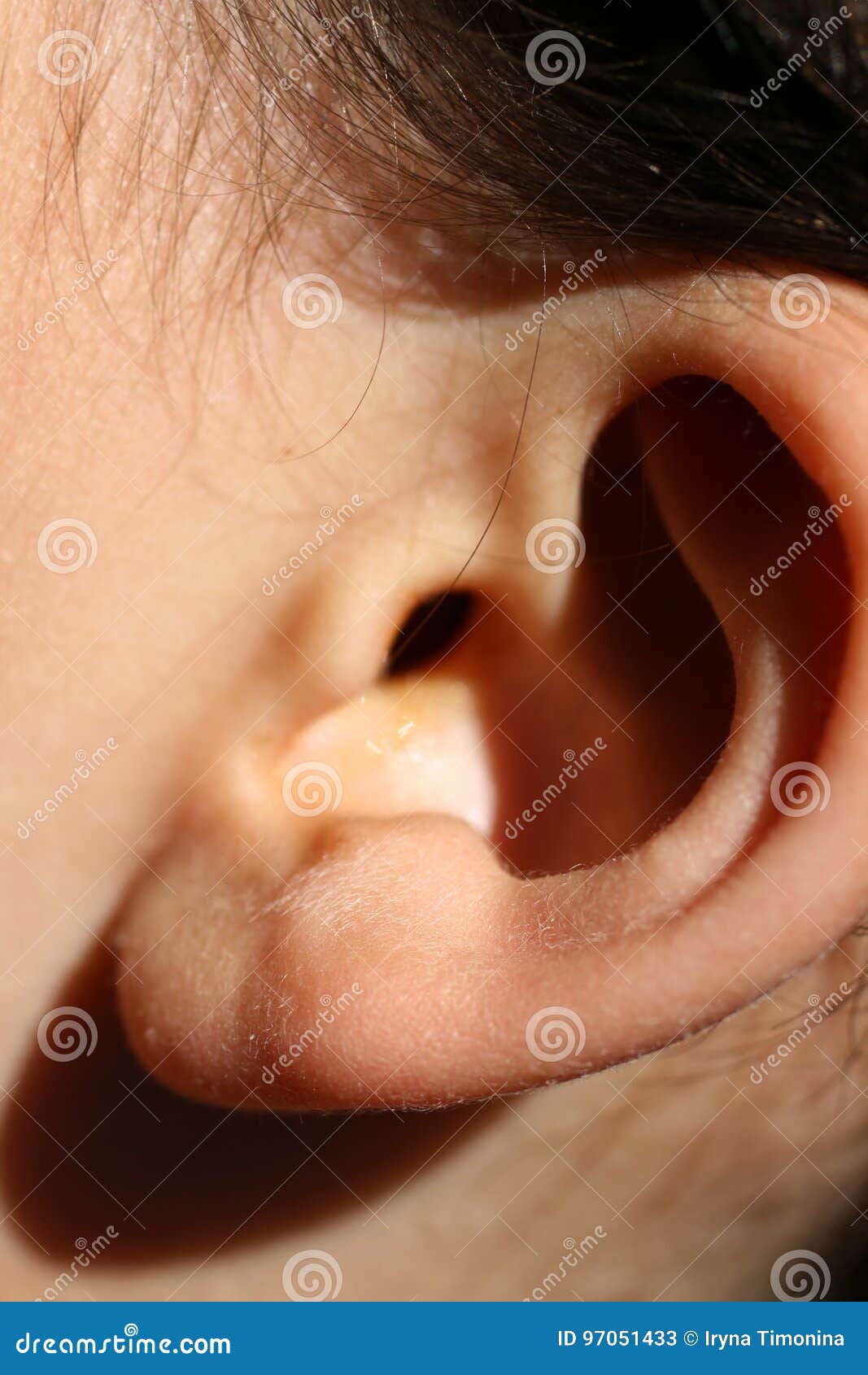Deformed Ear. Abnormal Development of the Auricle Stock Image Image