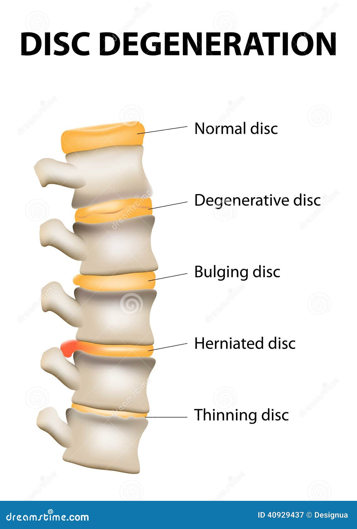 Degeneração do disco ilustração do vetor. Ilustração de doloroso - 40929437