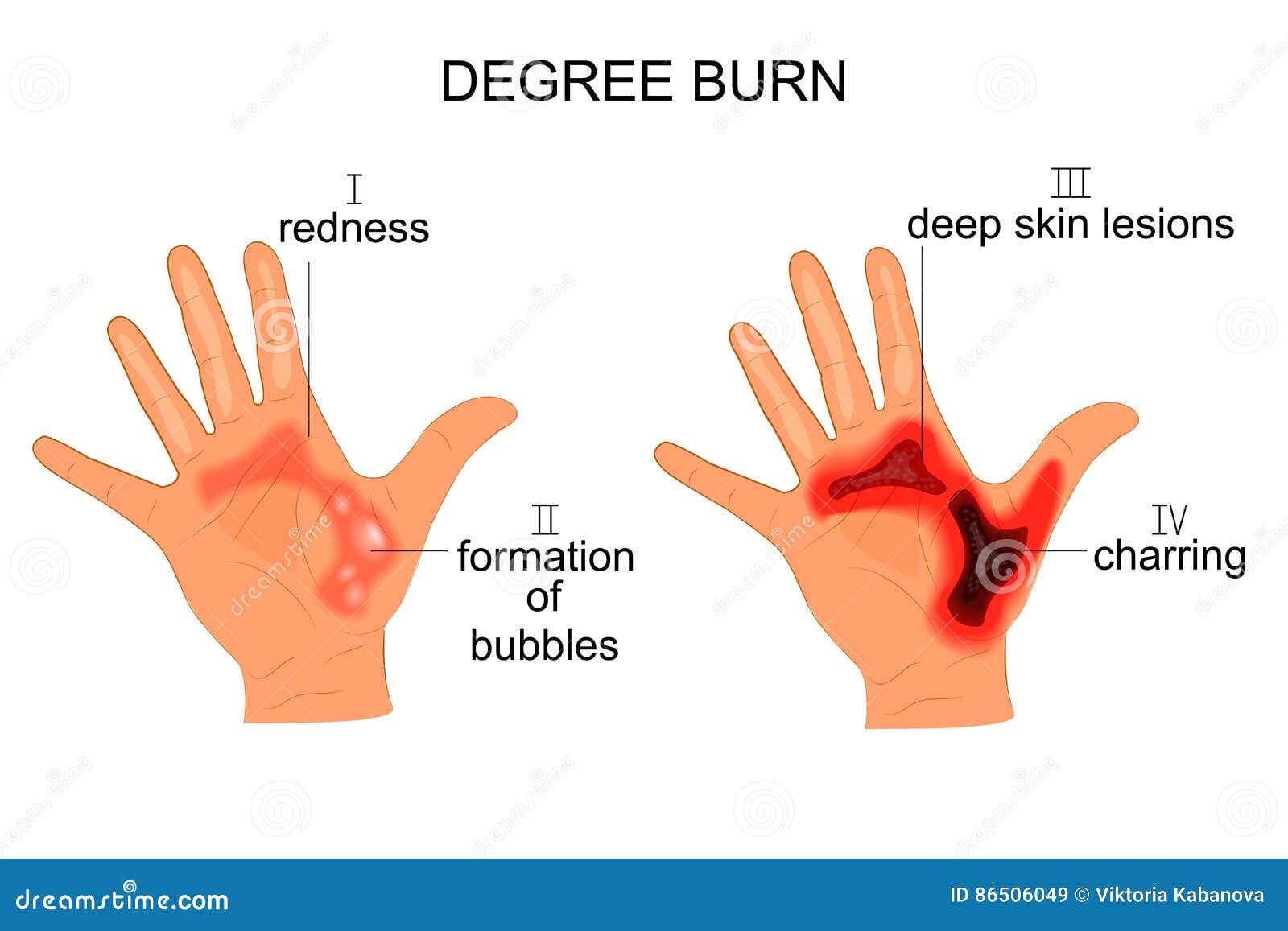 degree burn