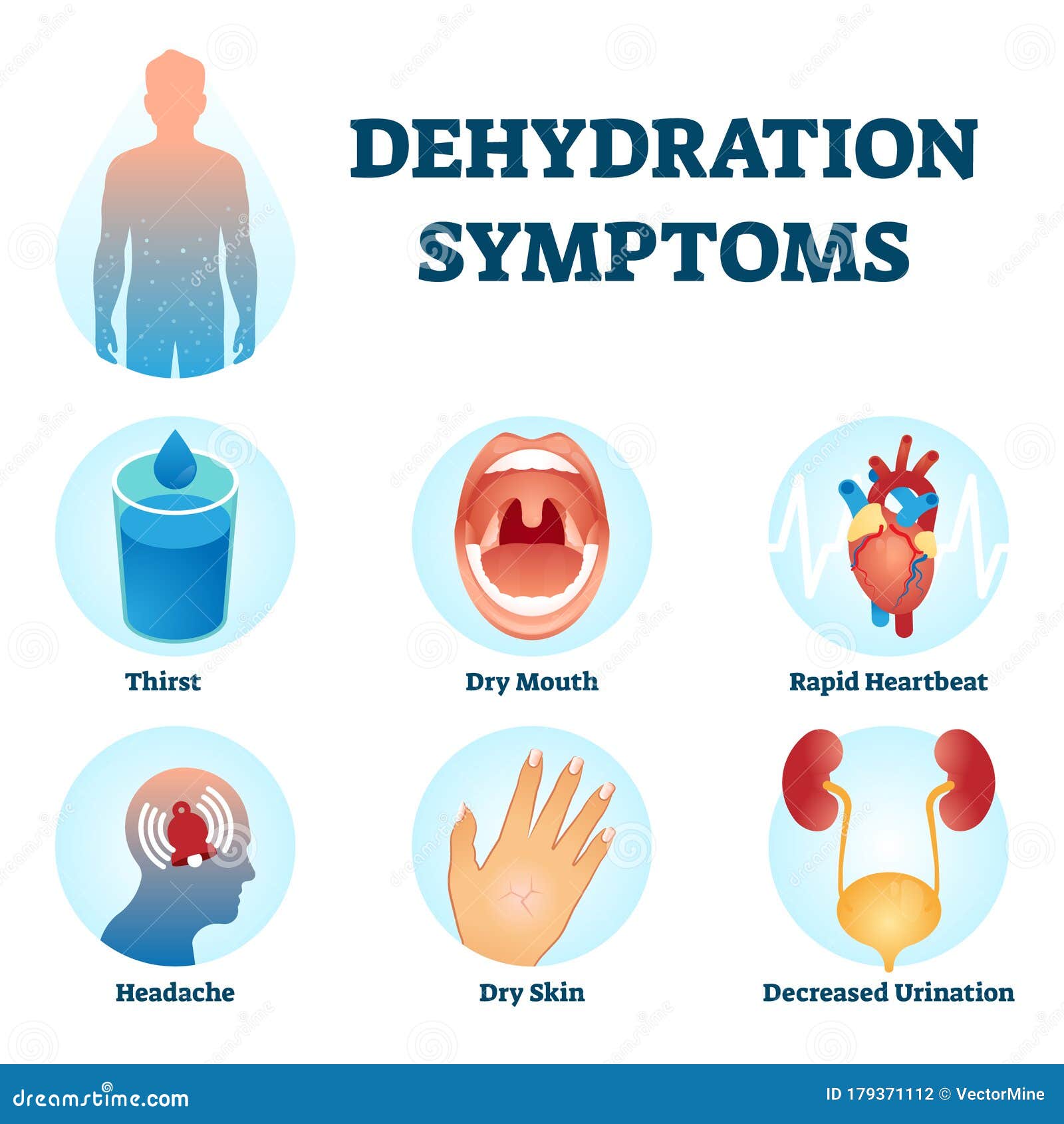 Dehydration Symptoms Illustrations – 169 Dehydration Symptoms Stock Illustrations, & Clipart -