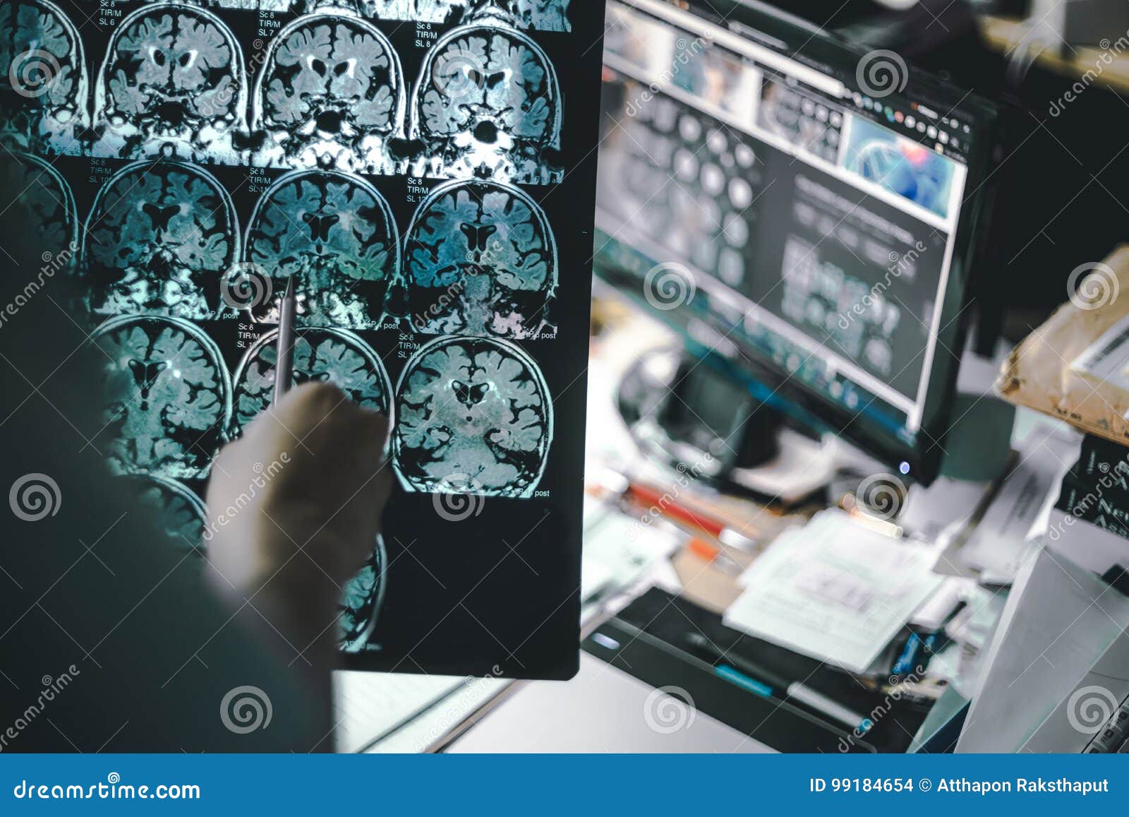 Dementia brain on MRI stock photo. Image of medical, imaging - 99184654