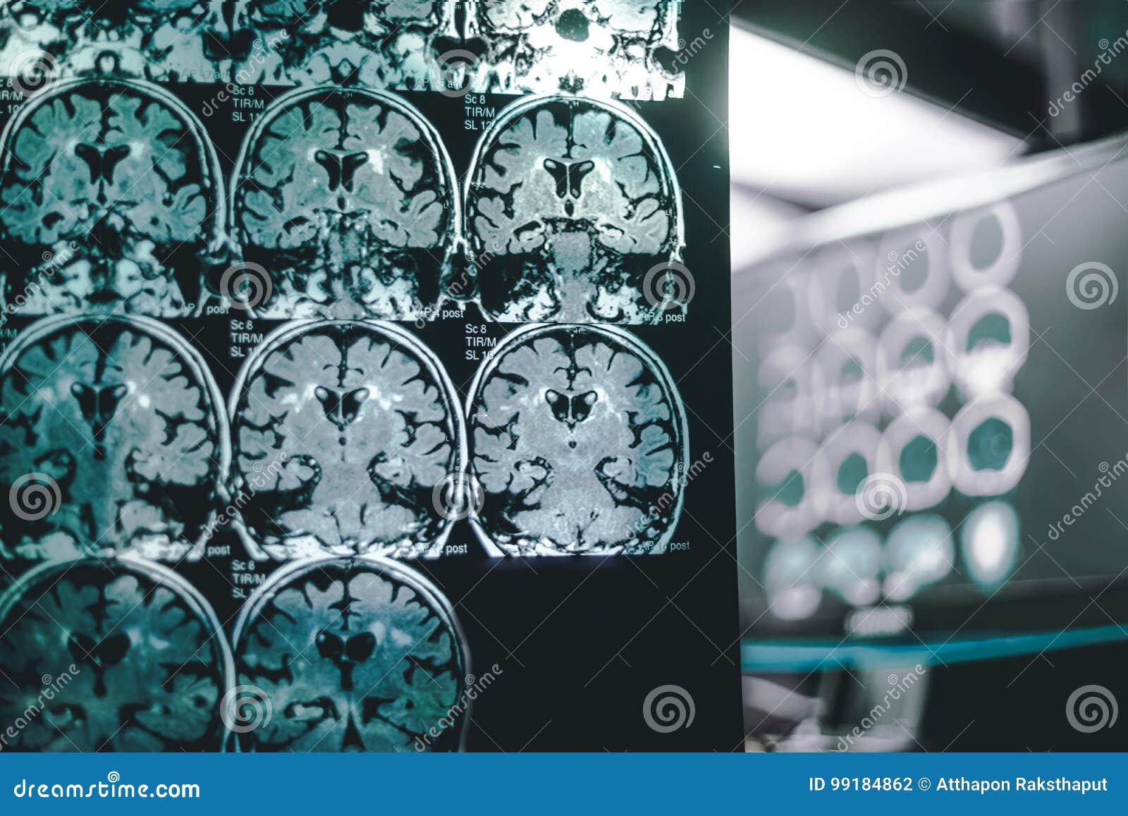 Dementia brain on MRI stock photo. Image of film, neurology - 99184862