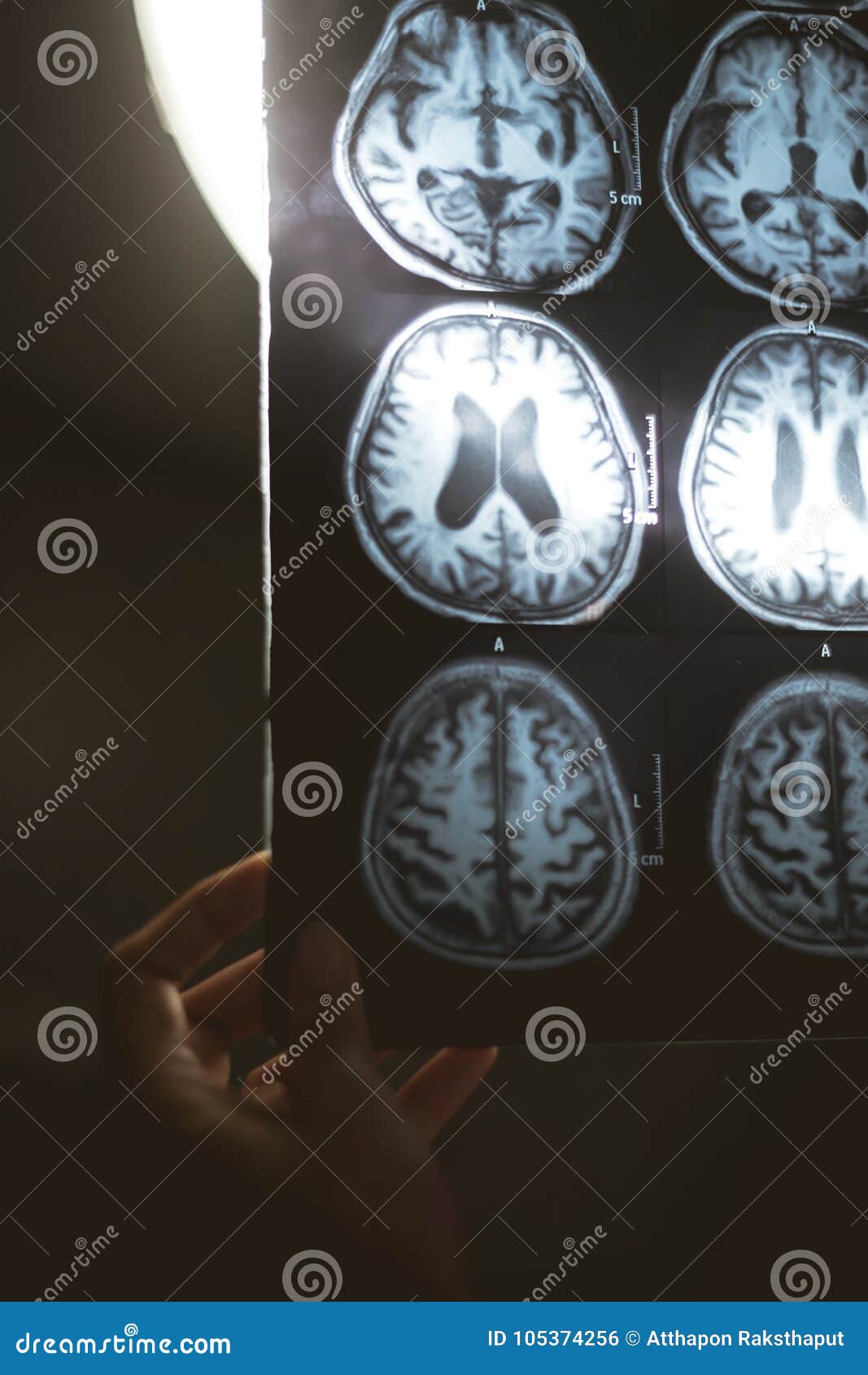 Brain MRI and dementia stock photo. Image of skull, medicines - 105374256
