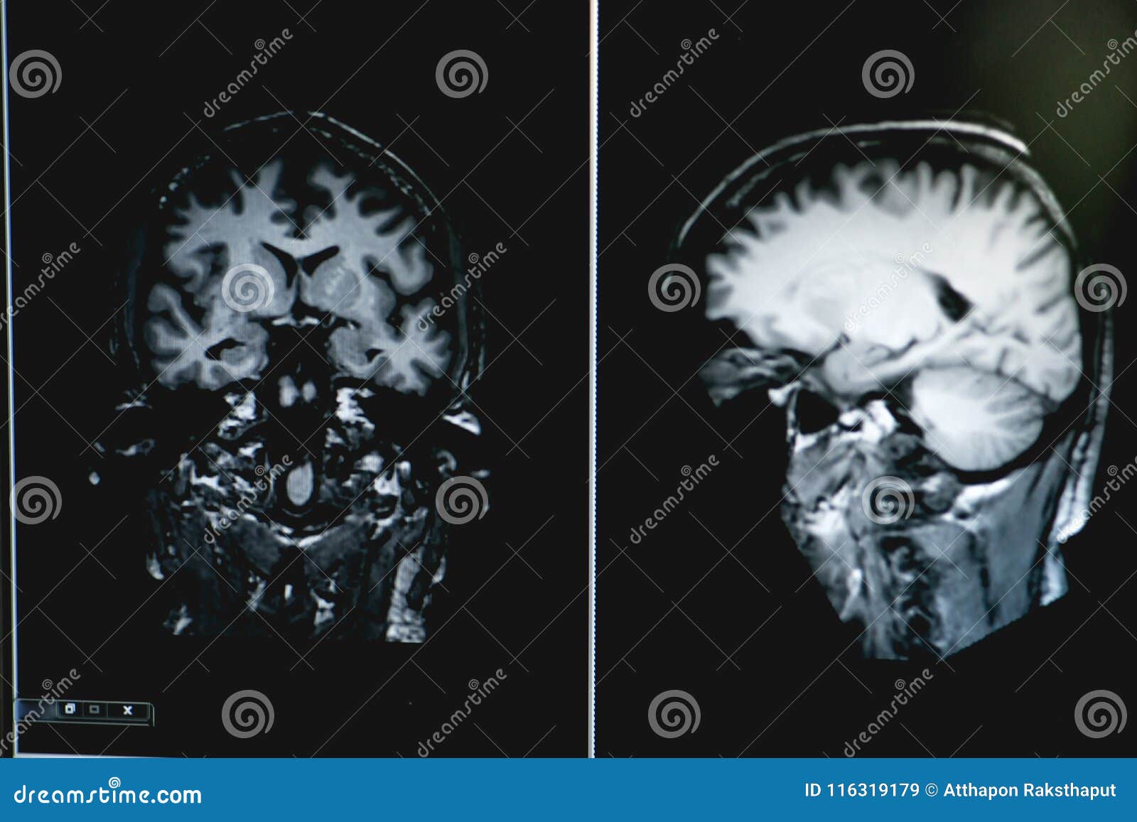 Dementia on MRI Film. Brain Dementia. Stock Image - Image of health