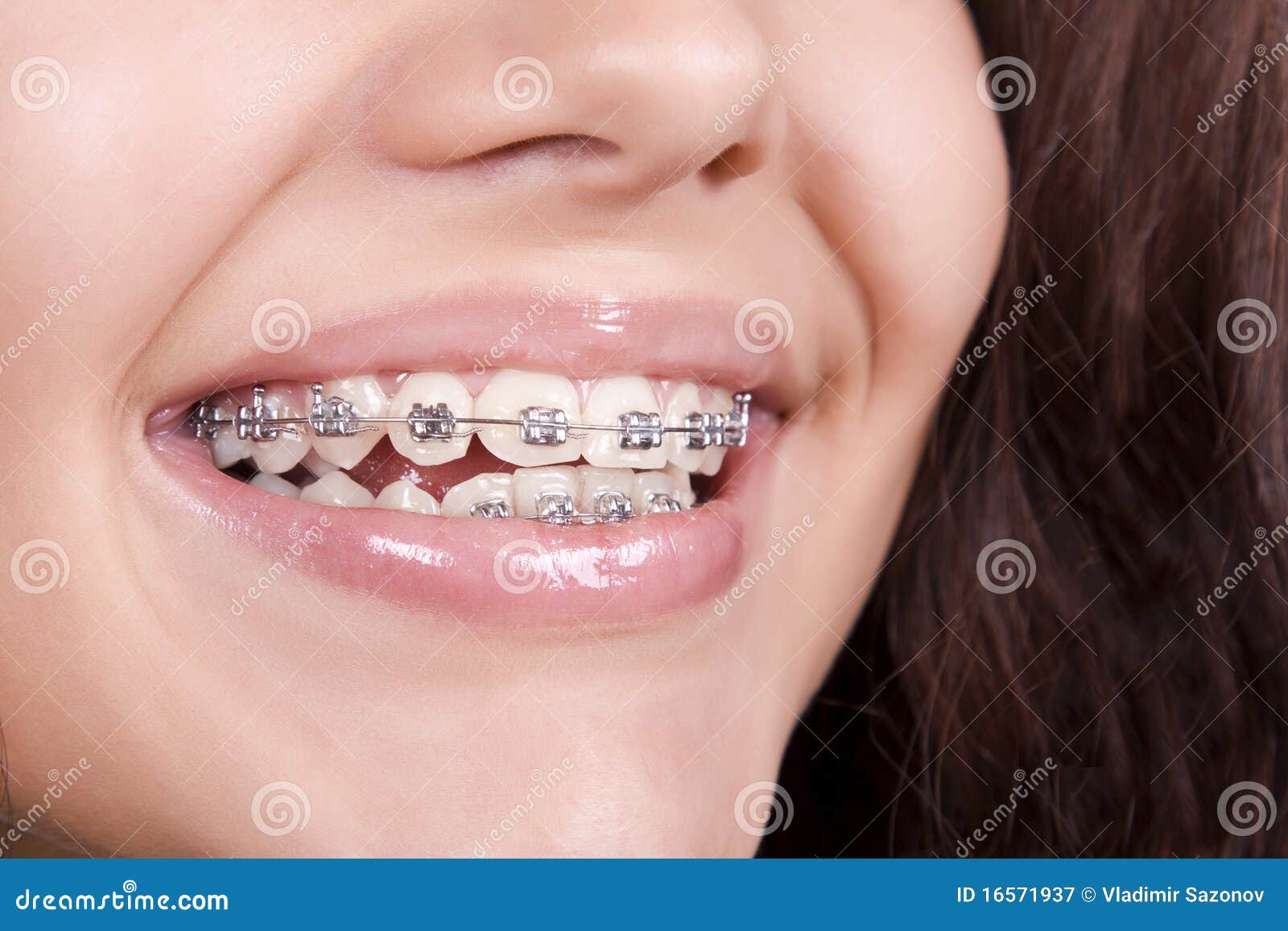 283 Braces Rubber Bands Stock Photos - Free & Royalty-Free Stock Photos  from Dreamstime