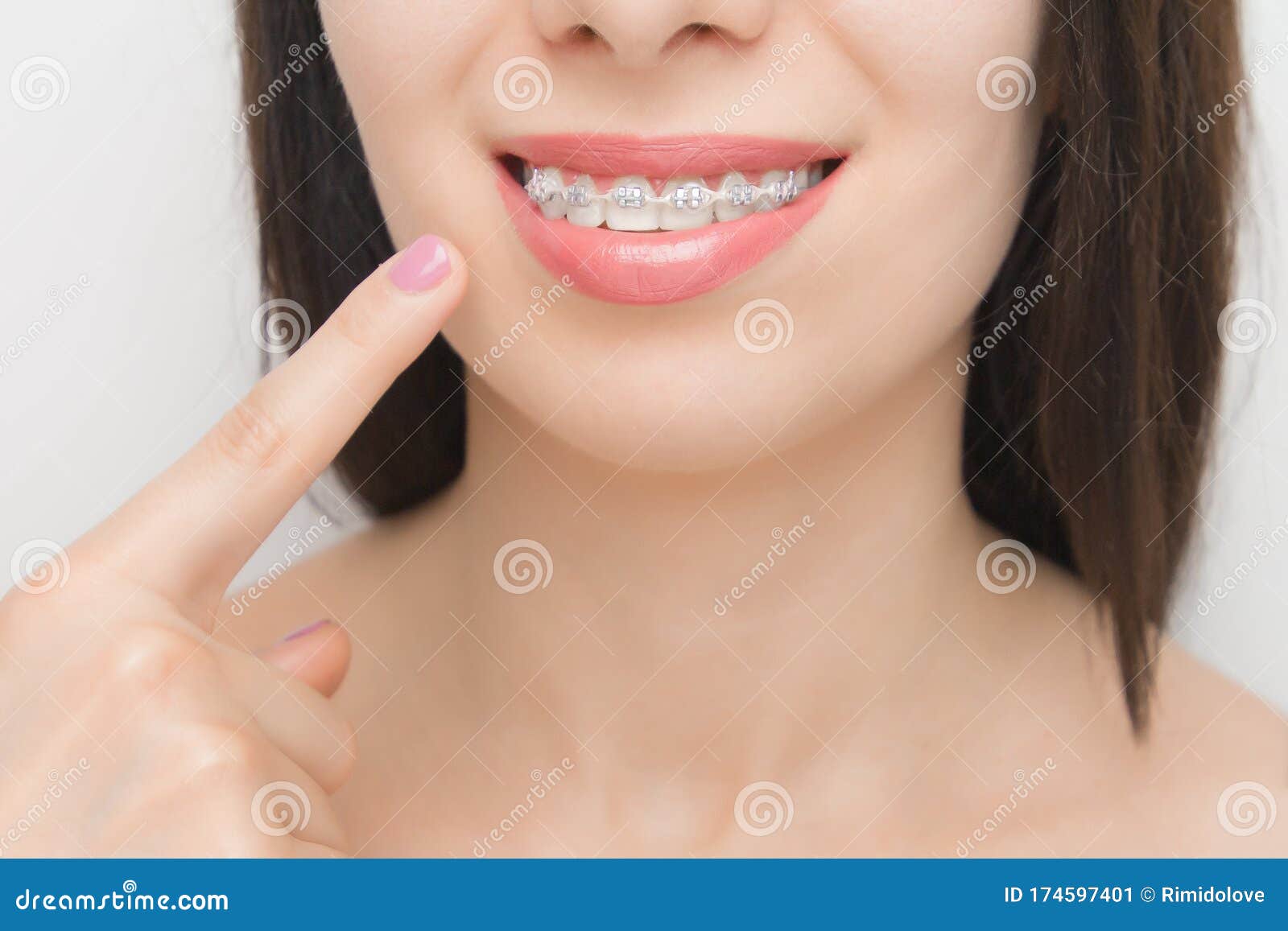 Dental Braces In Happy Womans Mouths Who Shows By Finger O