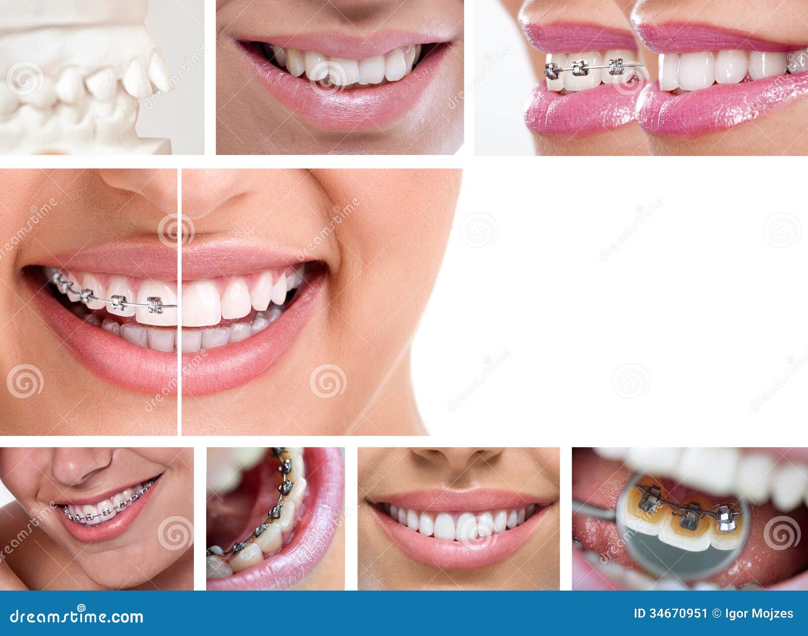 dental braces