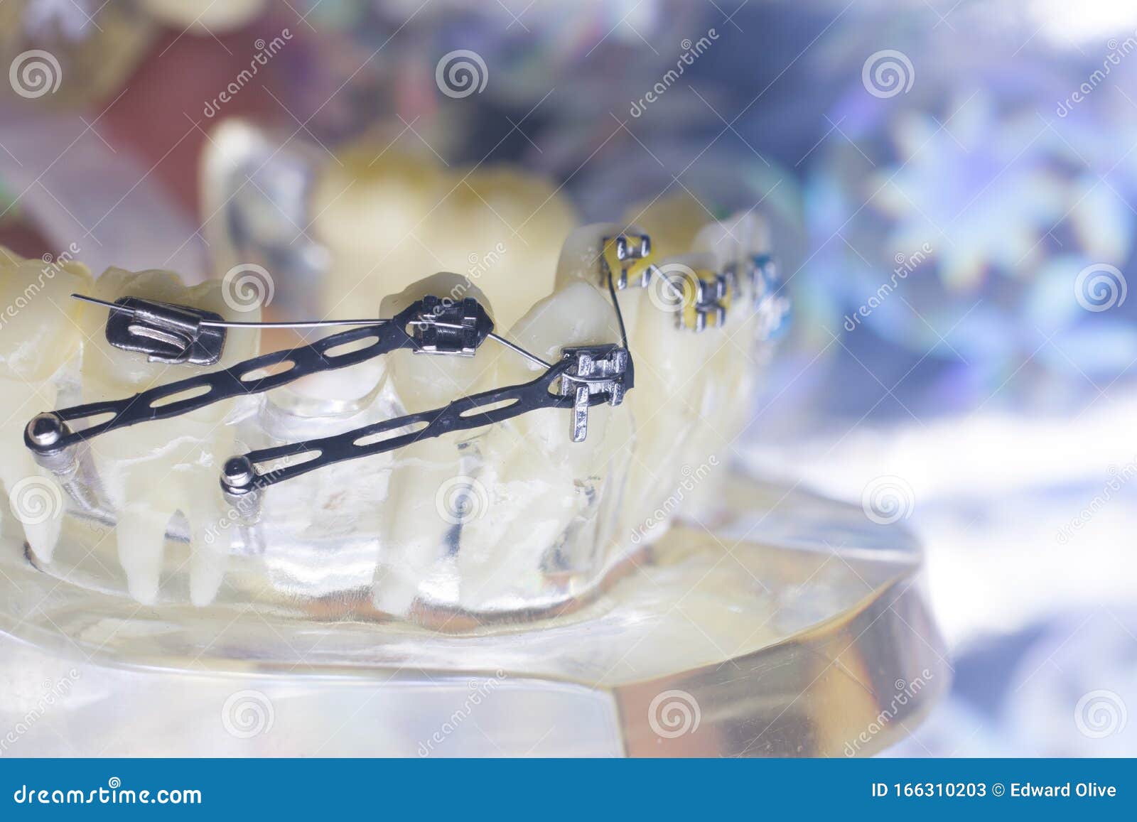 Dental Brackets Teeth Straighteners Stock Image Image of bracket