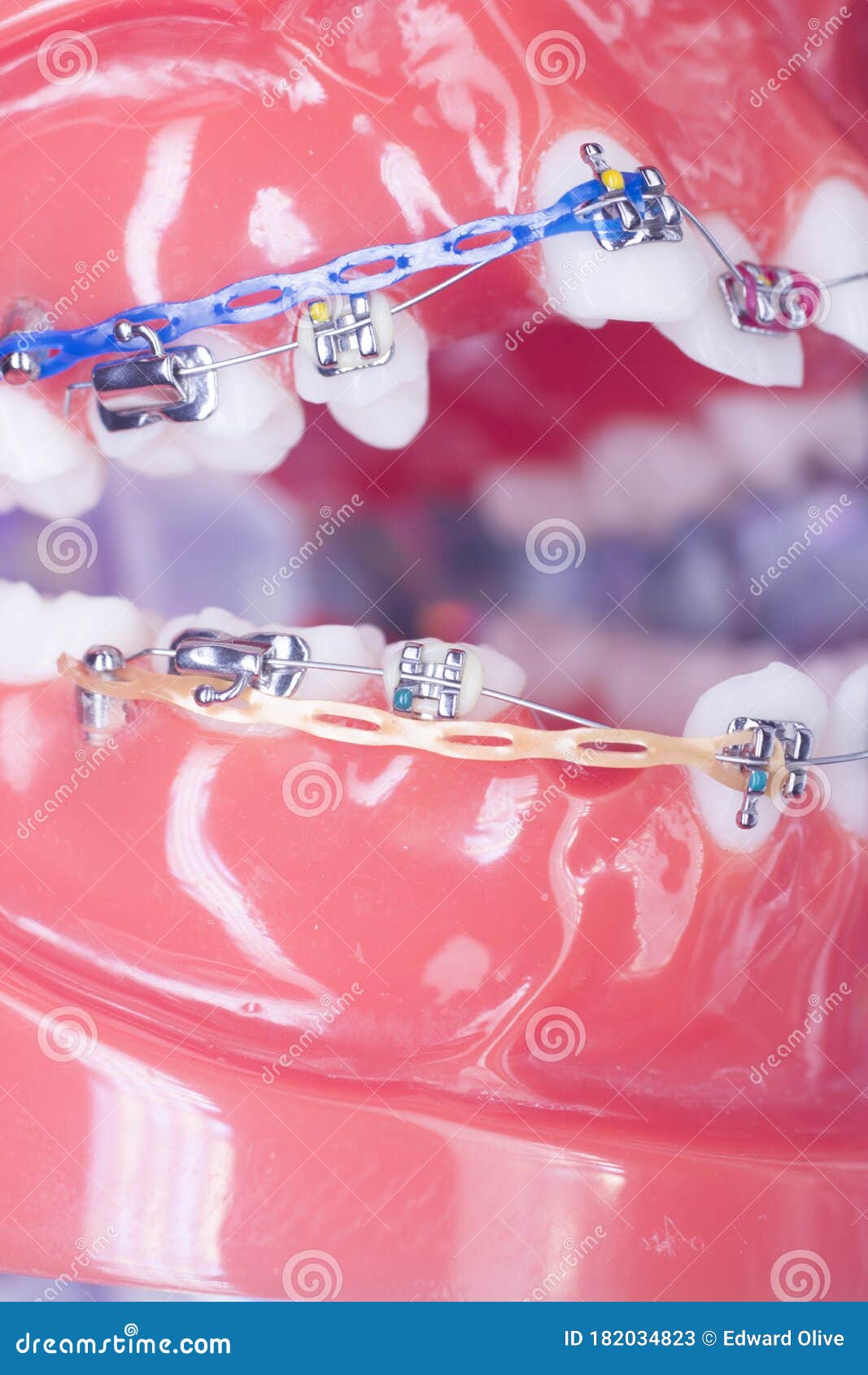Dental Brackets Teeth Straighteners Stock Image Image of health