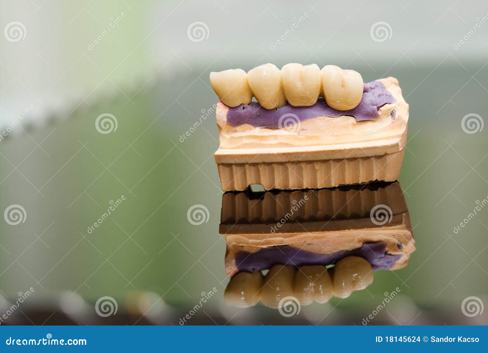 Dental Bridge Made of Porcelain on Casting Stock Photo Image of