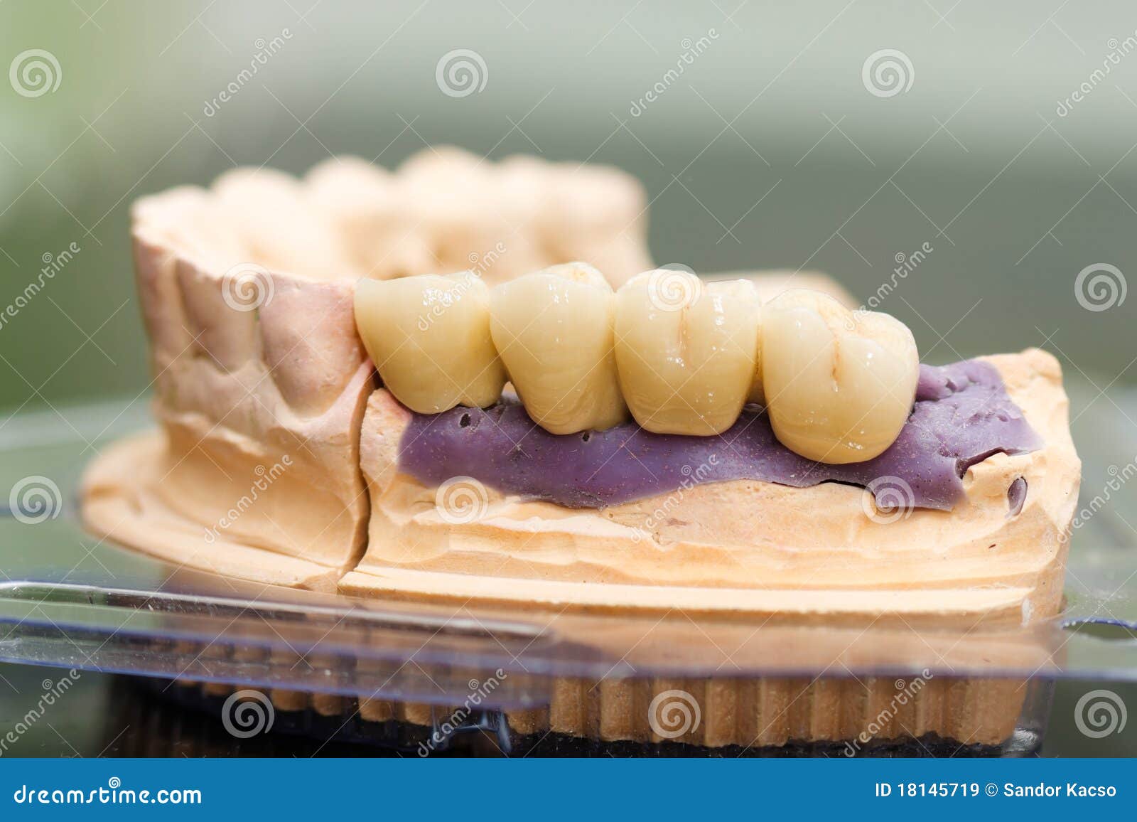 dental bridge made of porcelain on casting