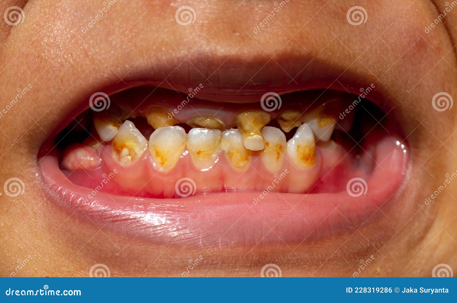 Dental Caries on a Child, in Front Teeth. Dental Care Concept Stock