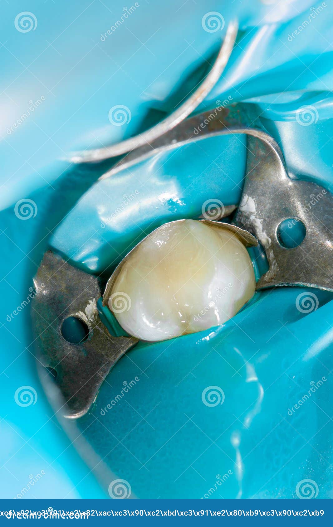caries and tooth disease. filling with a dental composite photopolymer material using rubber dam. the concept of dental treatment