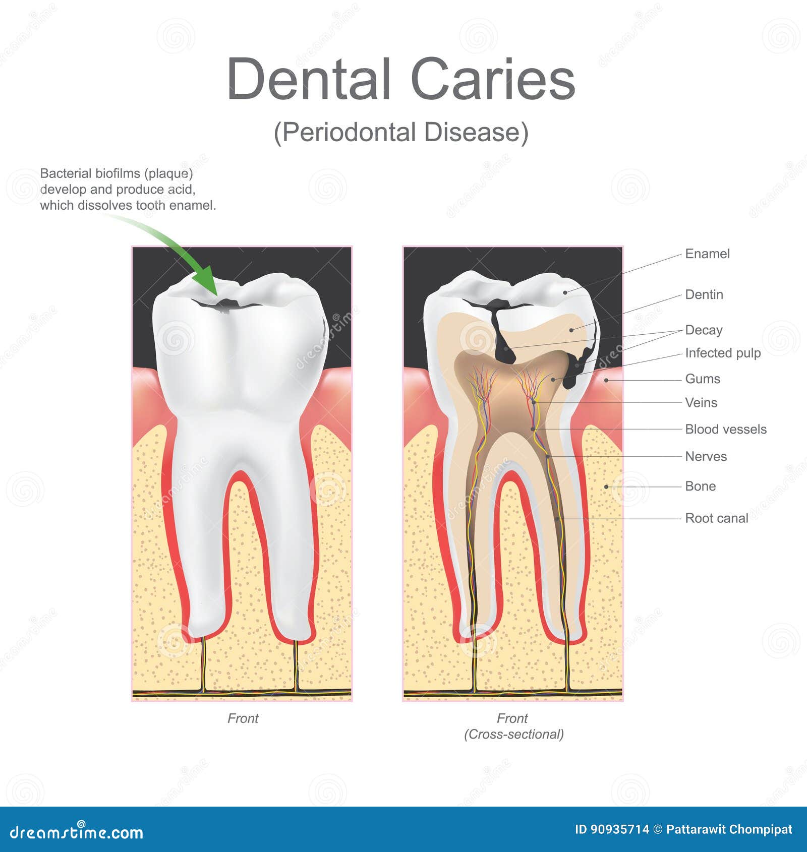 Dental Caries Periodontal Disease. Stock Vector - Illustration of