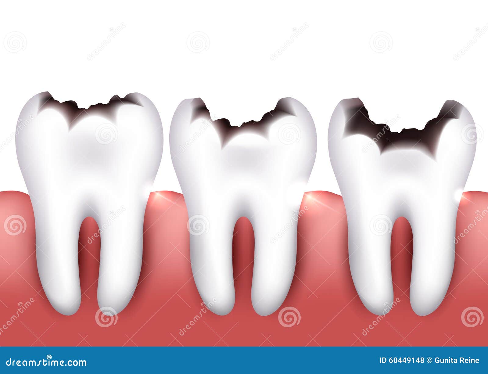 dental caries