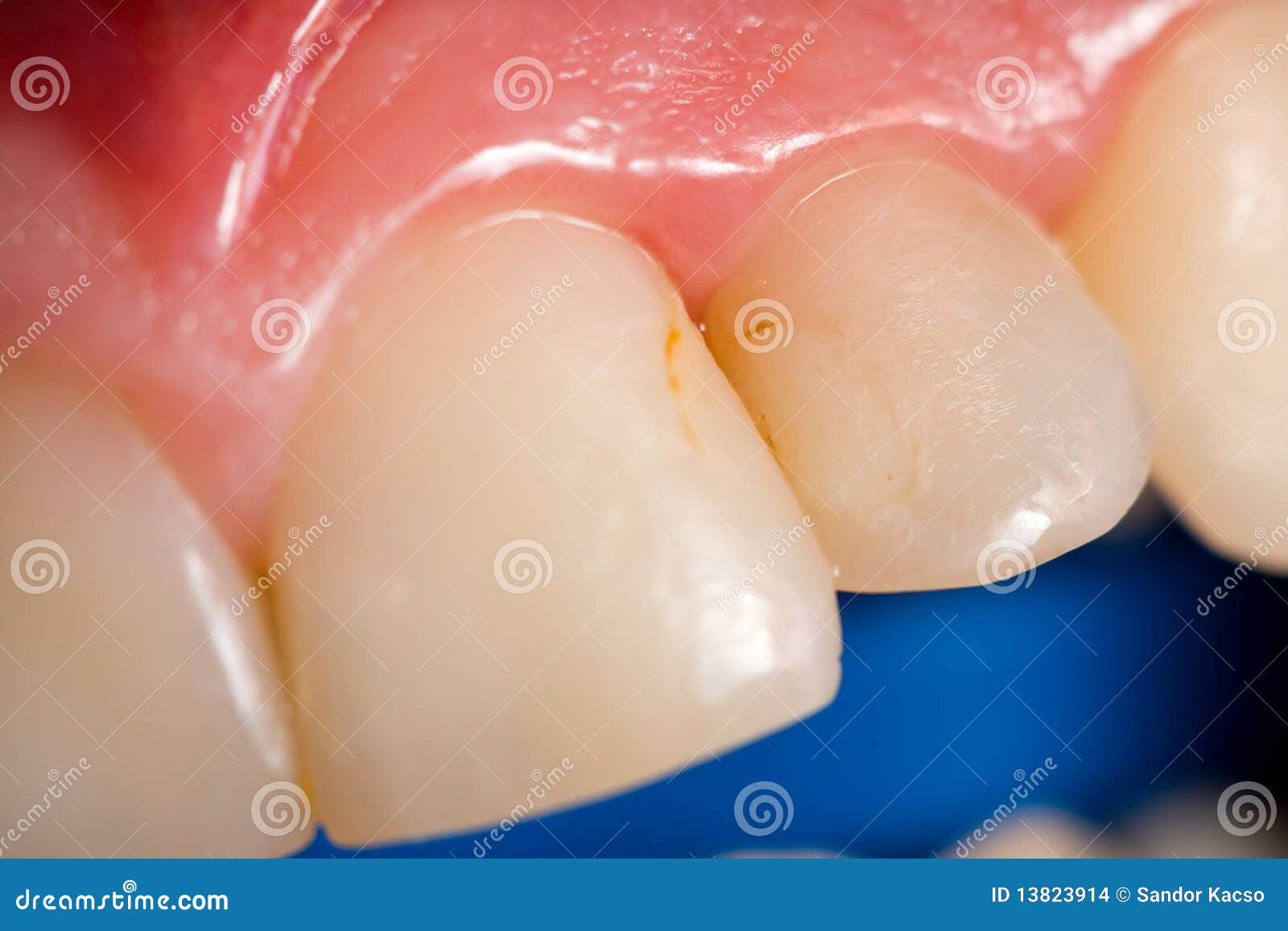 secondary caries