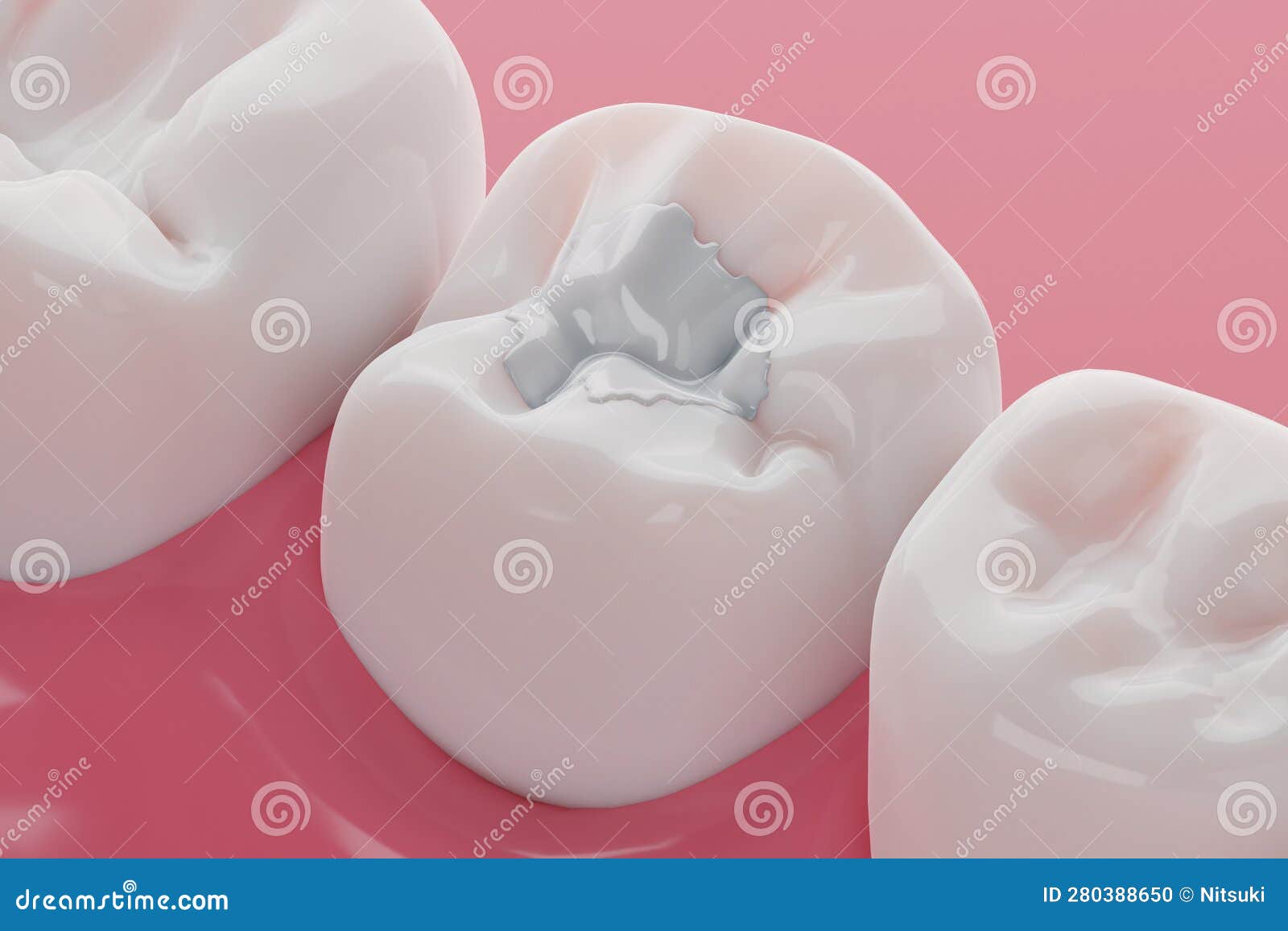 Dental Composite White Amalgam Stock Illustration Illustration of