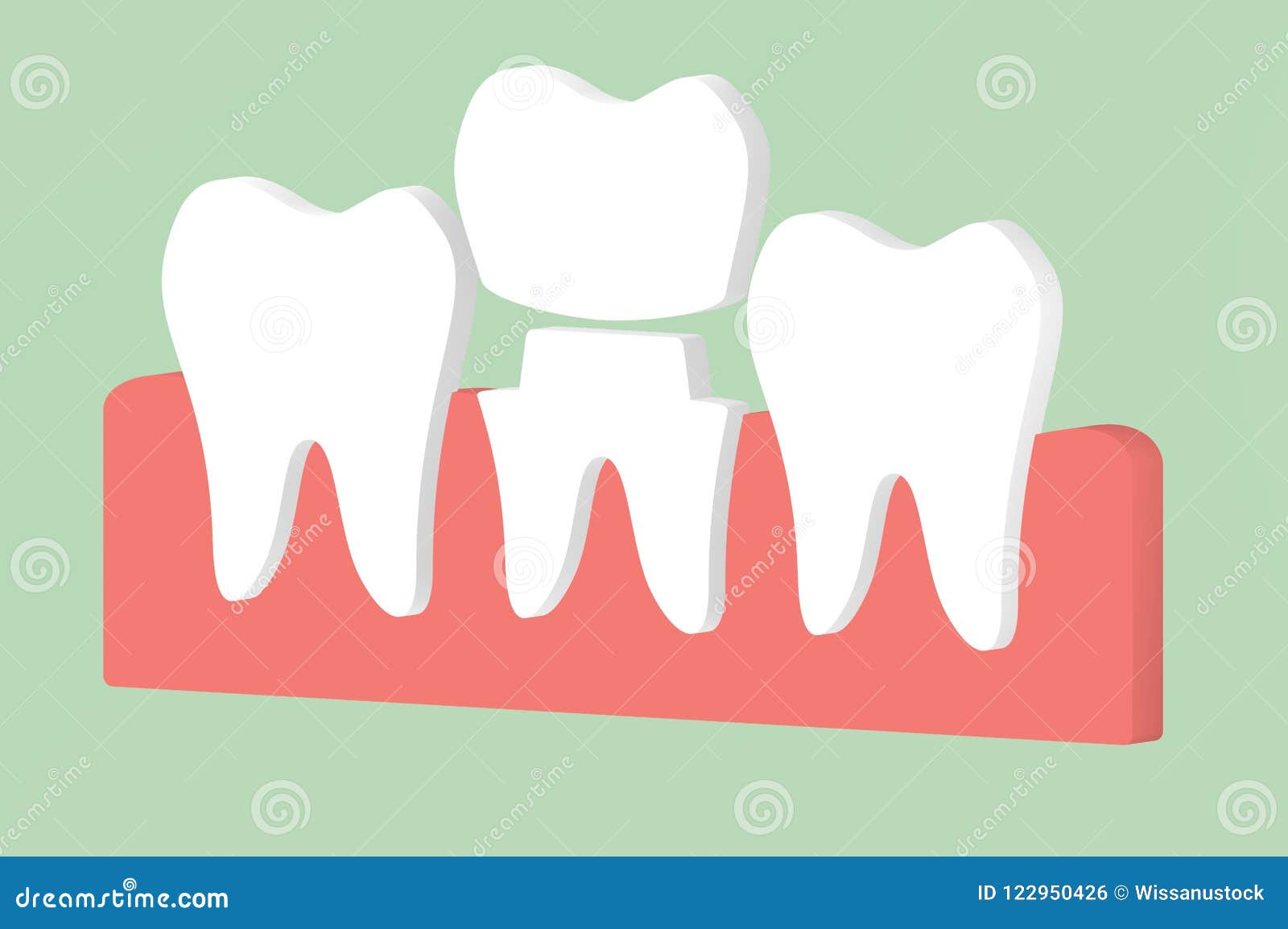 Dental Crown, Installation Process and Change of Teeth Stock