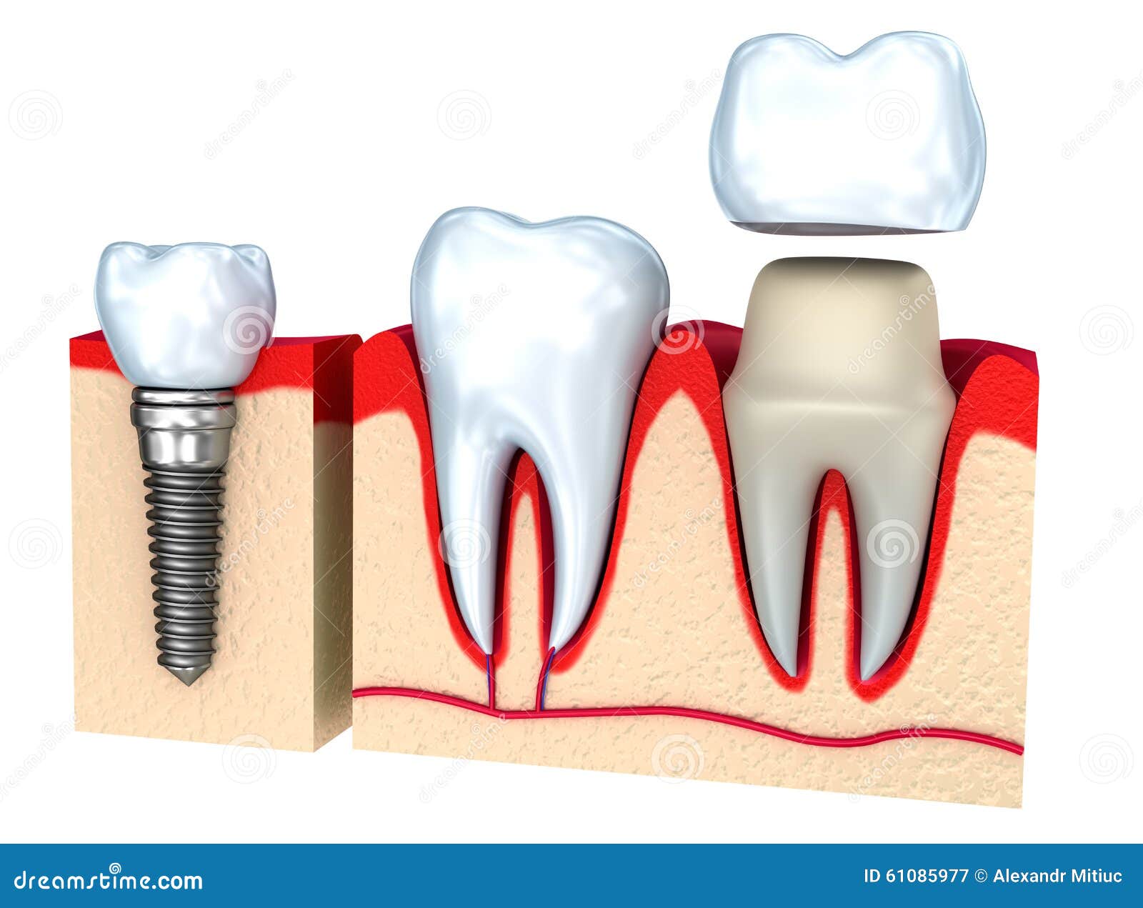 Dental Crown Installation Process Stock Illustration Illustration of