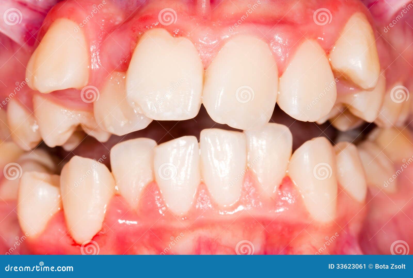 dental displacement