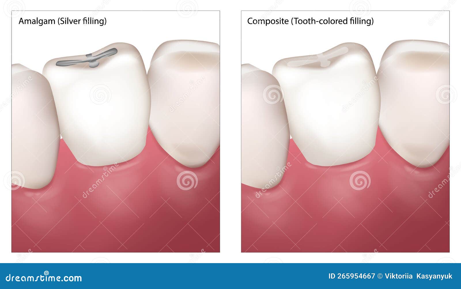Composite vs Silver Dental Filling