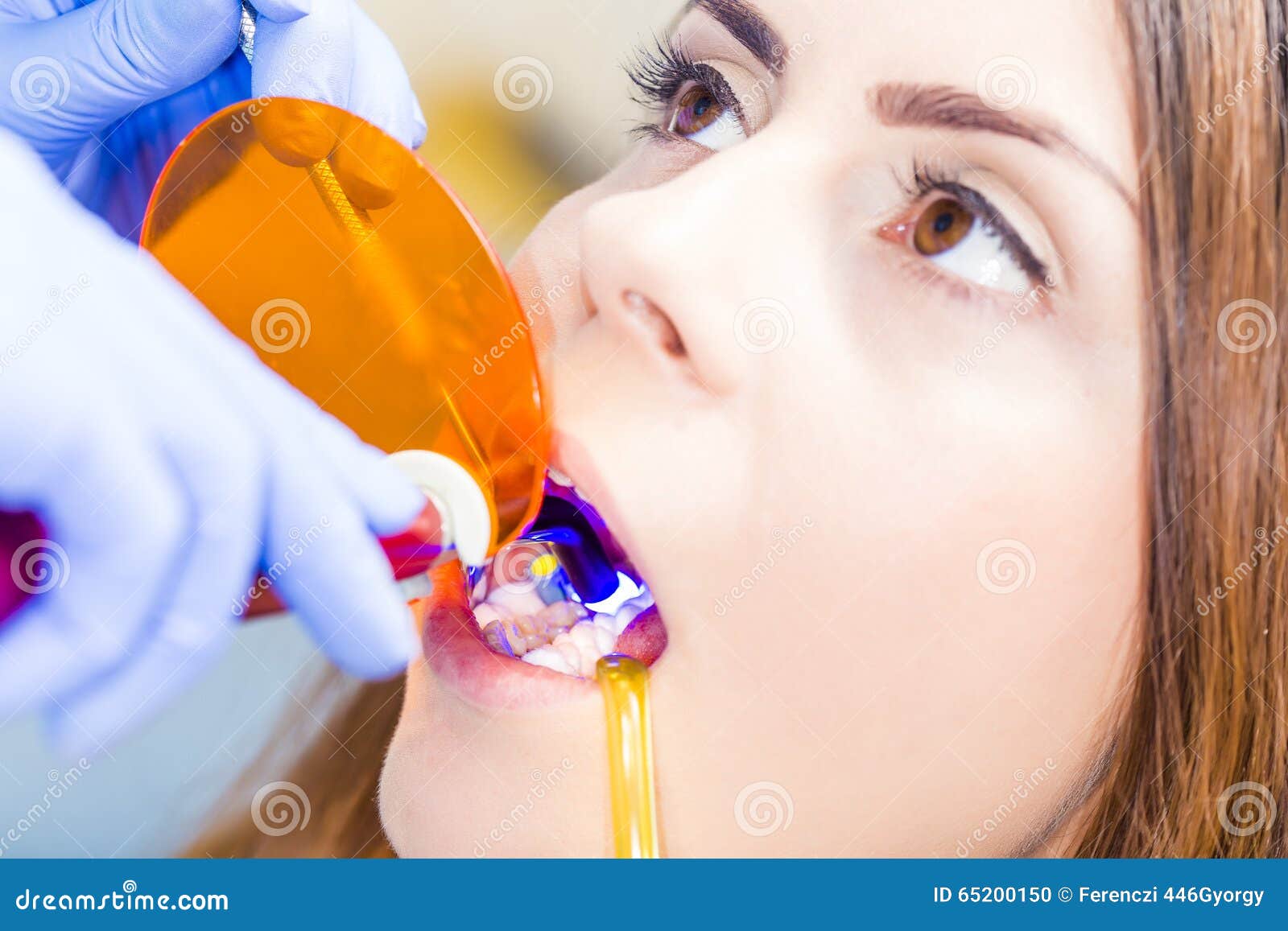 Dental filling procedure stock photo. Image of bonding 65200150
