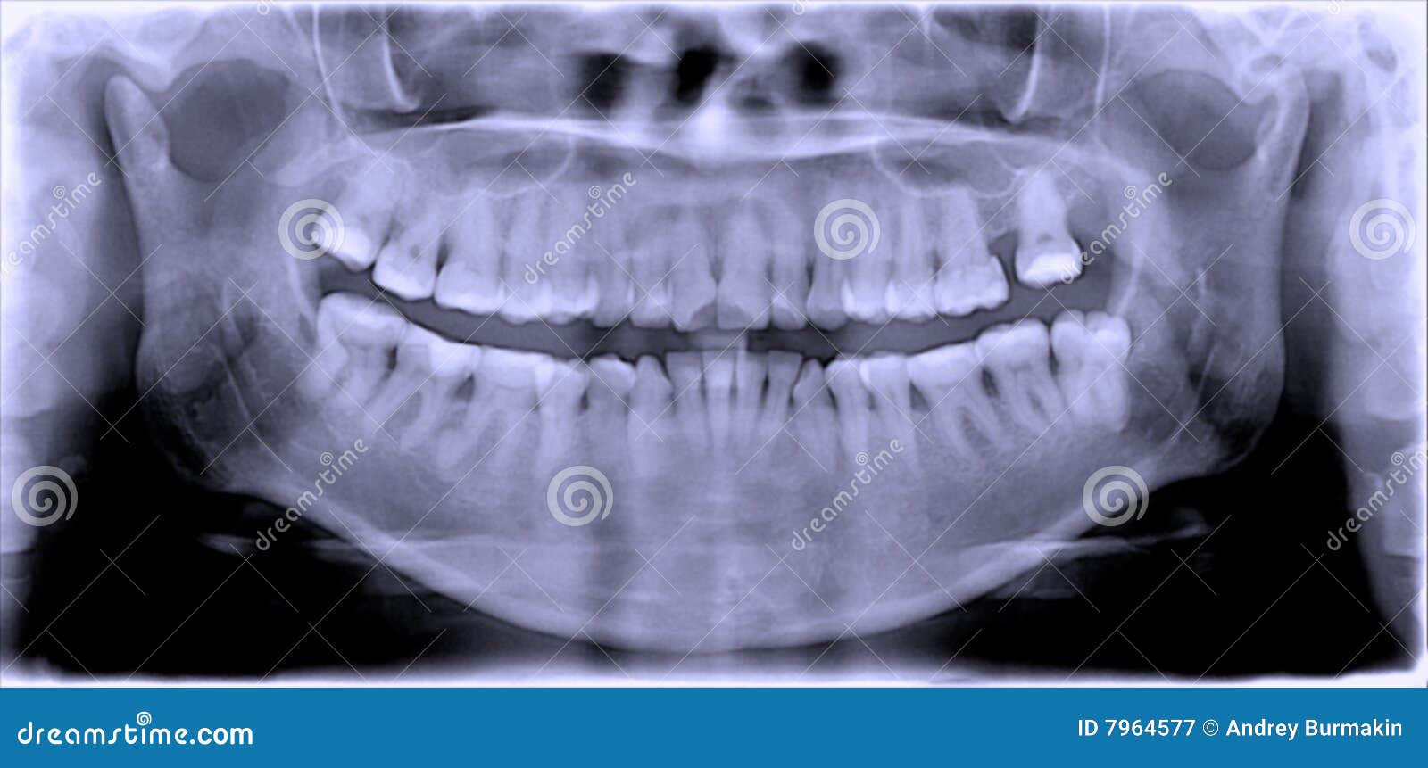 Dental film stock image. Image of films, dentists, orthodontic 7964577