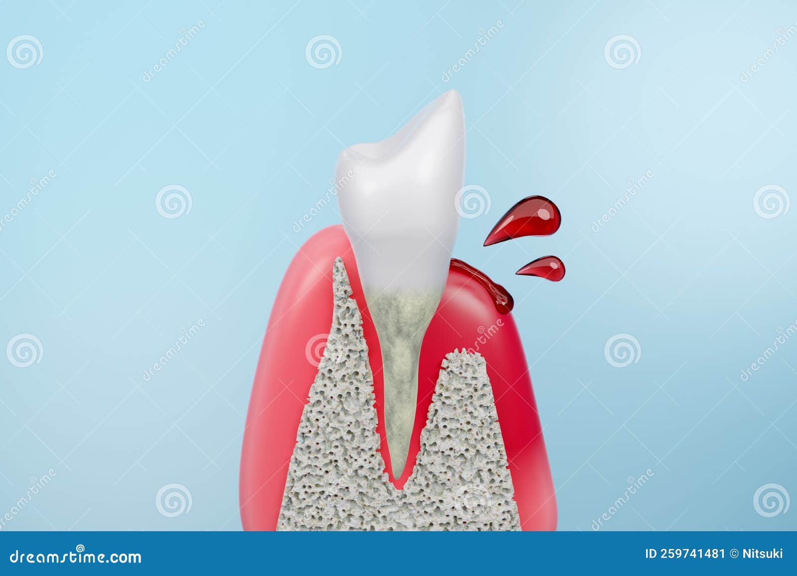Dental Gum Disease, Bleeding at Root of Teeth Stock Illustration