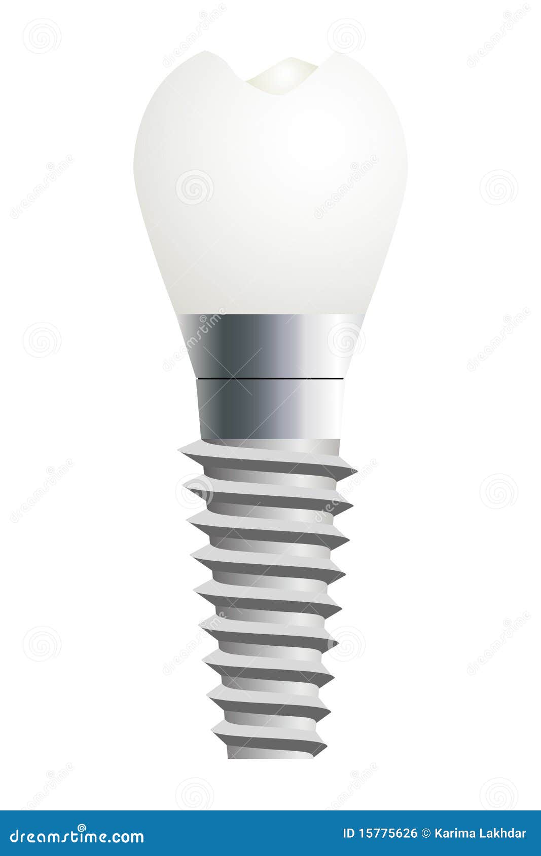 Download Dental Implant stock vector. Illustration of orthopedic ...