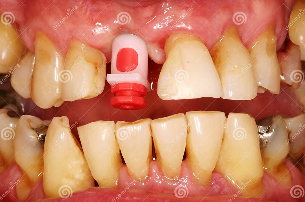 DENTAL IMPLANT stock image. Image of cuspid, palatal 19857901