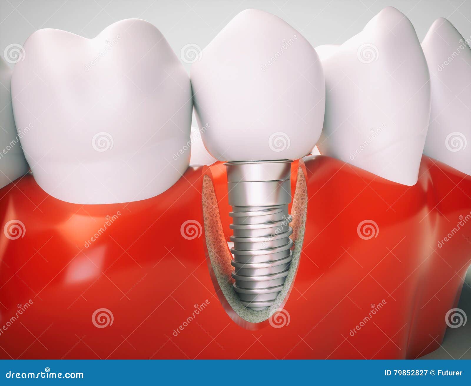 Dental Implant Temporary Abutment Stock Image
