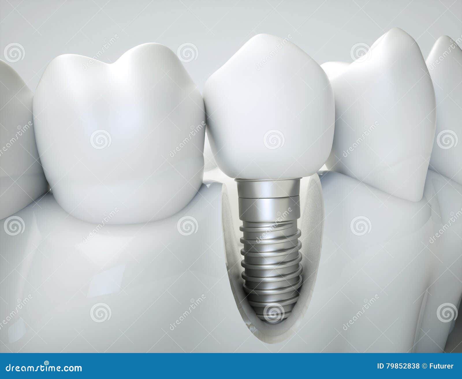 dental implant - 3d rendering