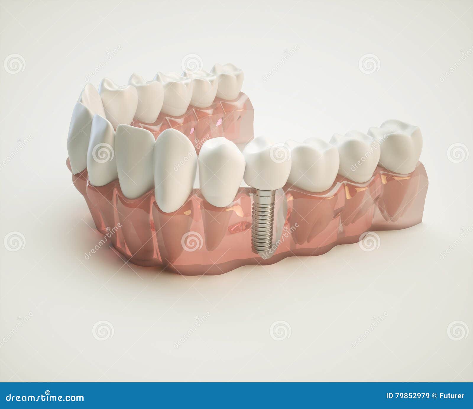 dental implant - 3d rendering