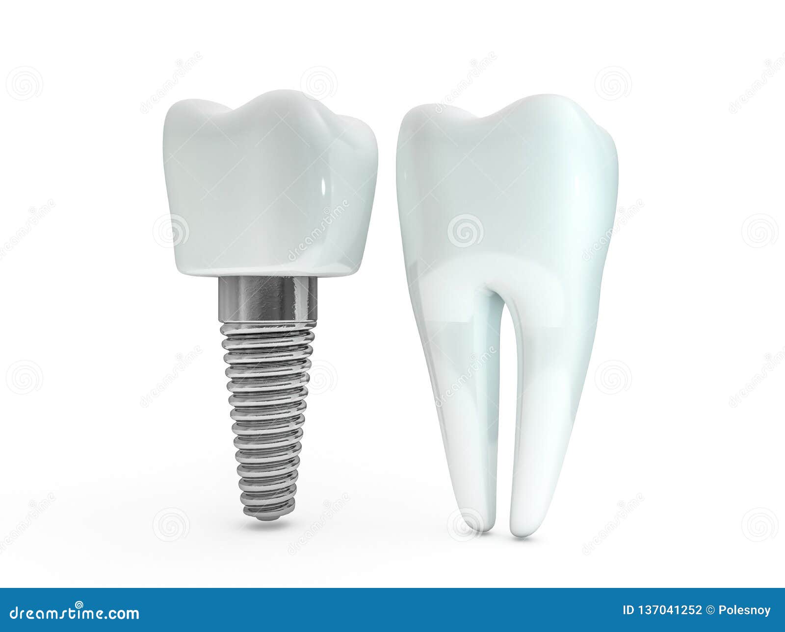 dental implant dentist, tooth layout, plastics, man, teeth, treatment. 3d