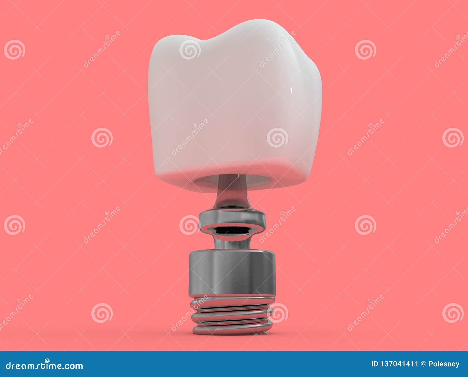 dental implant dentist, tooth layout, plastics, man, teeth, treatment. 3d
