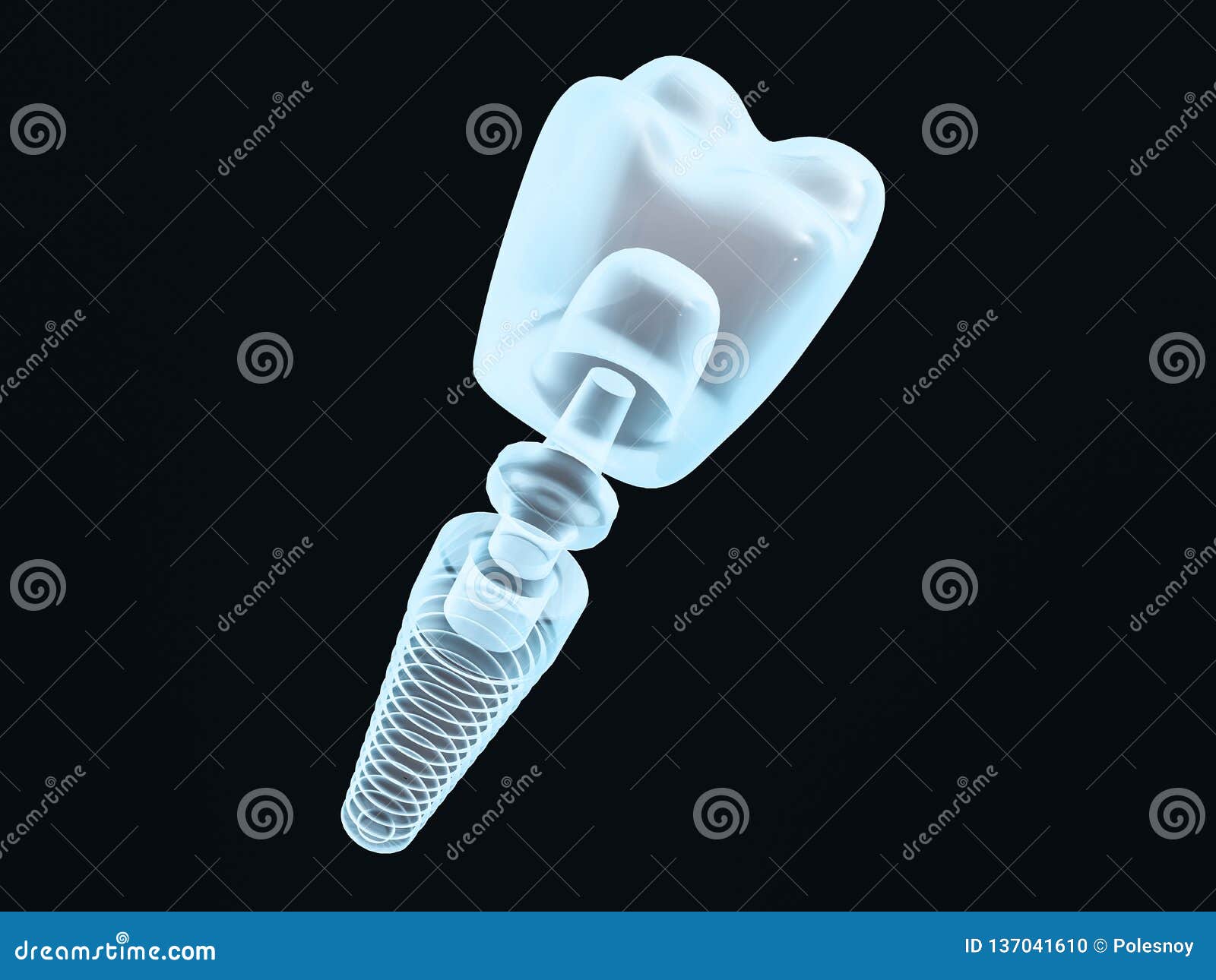 dental implant dentist, tooth layout, plastics, man, teeth, treatment. 3d