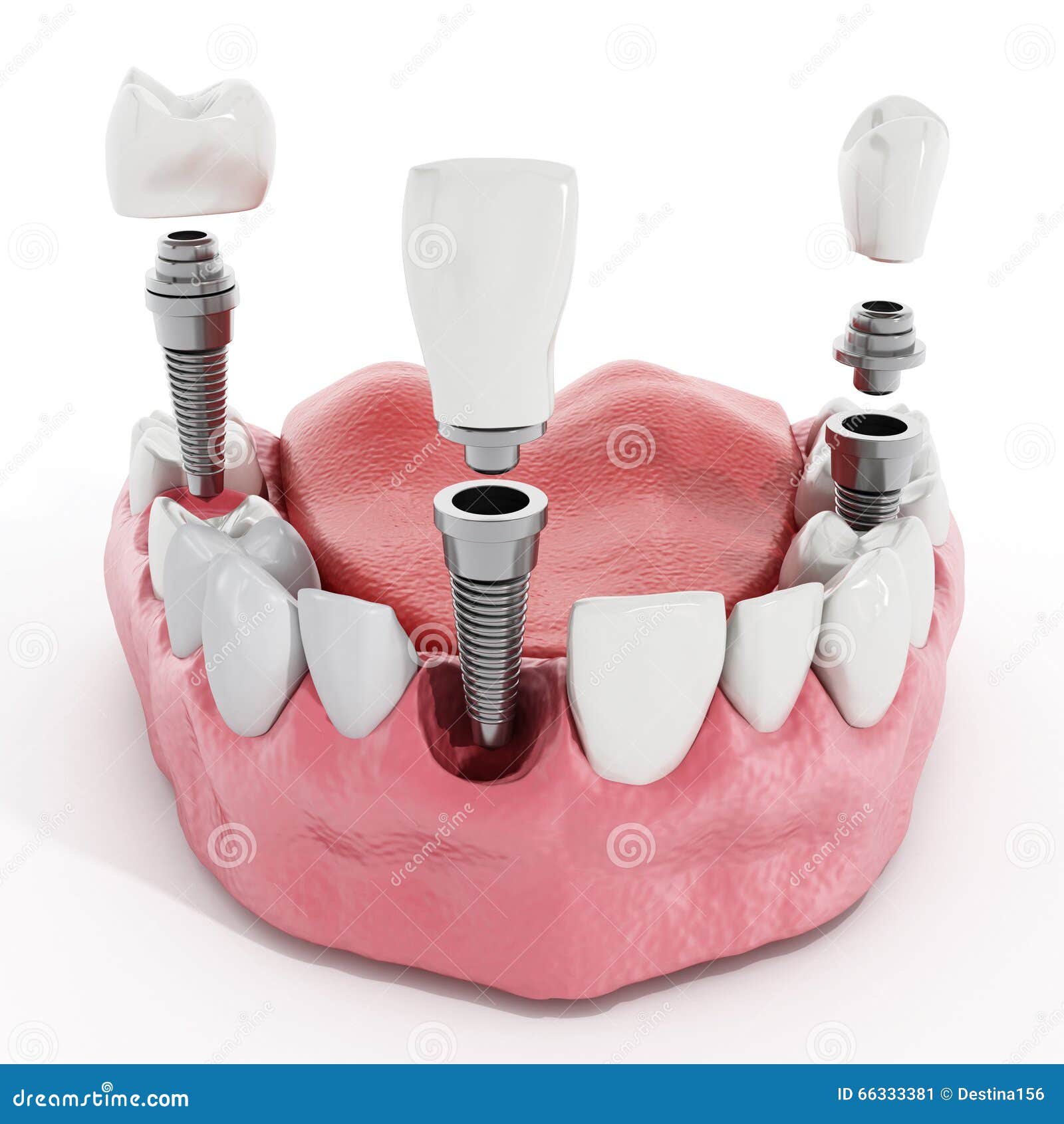 dental implant detail